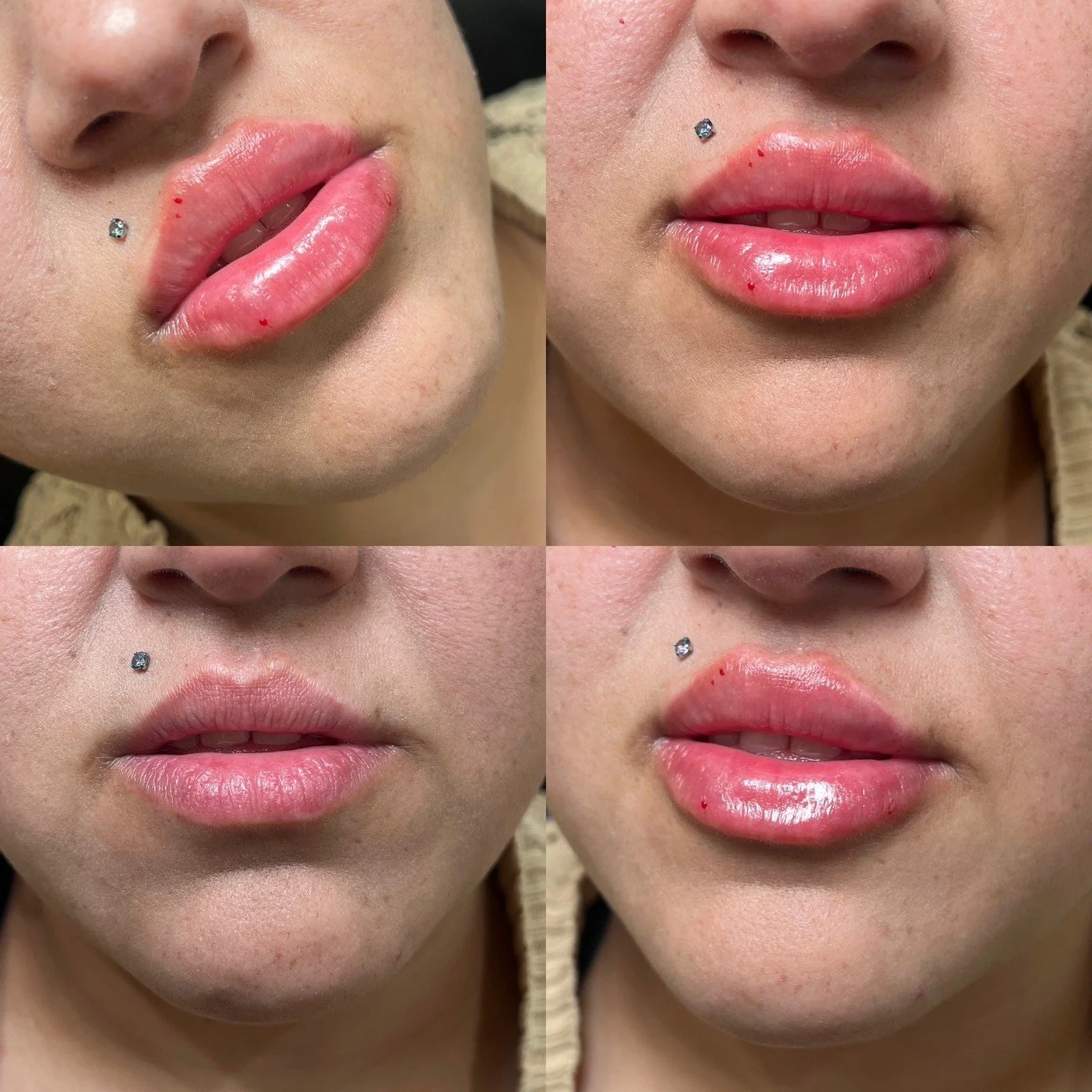 Russian Lip Filler by our lead injector Emma 

This goal was vertical height and a more defined shape. We utilized the Russian Lip Technique for maximum height and volume to achieve her goals. 

Location: Plump Medspa 
Service: Lip Filler 

&bull; Im