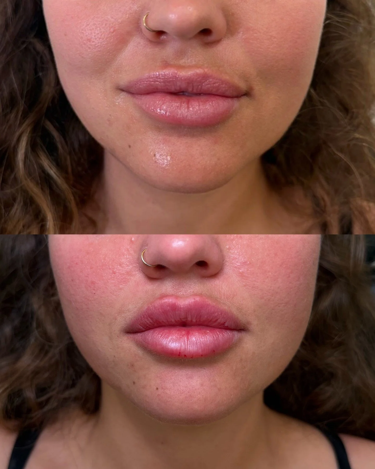 Building lips slowly creates the best long-term results.

This patient has had her lips enhanced over 3 sessions, allowing us to gradually build shape, balance, and volume while maintaining the integrity of the lips. A slow, intentional approach alwa