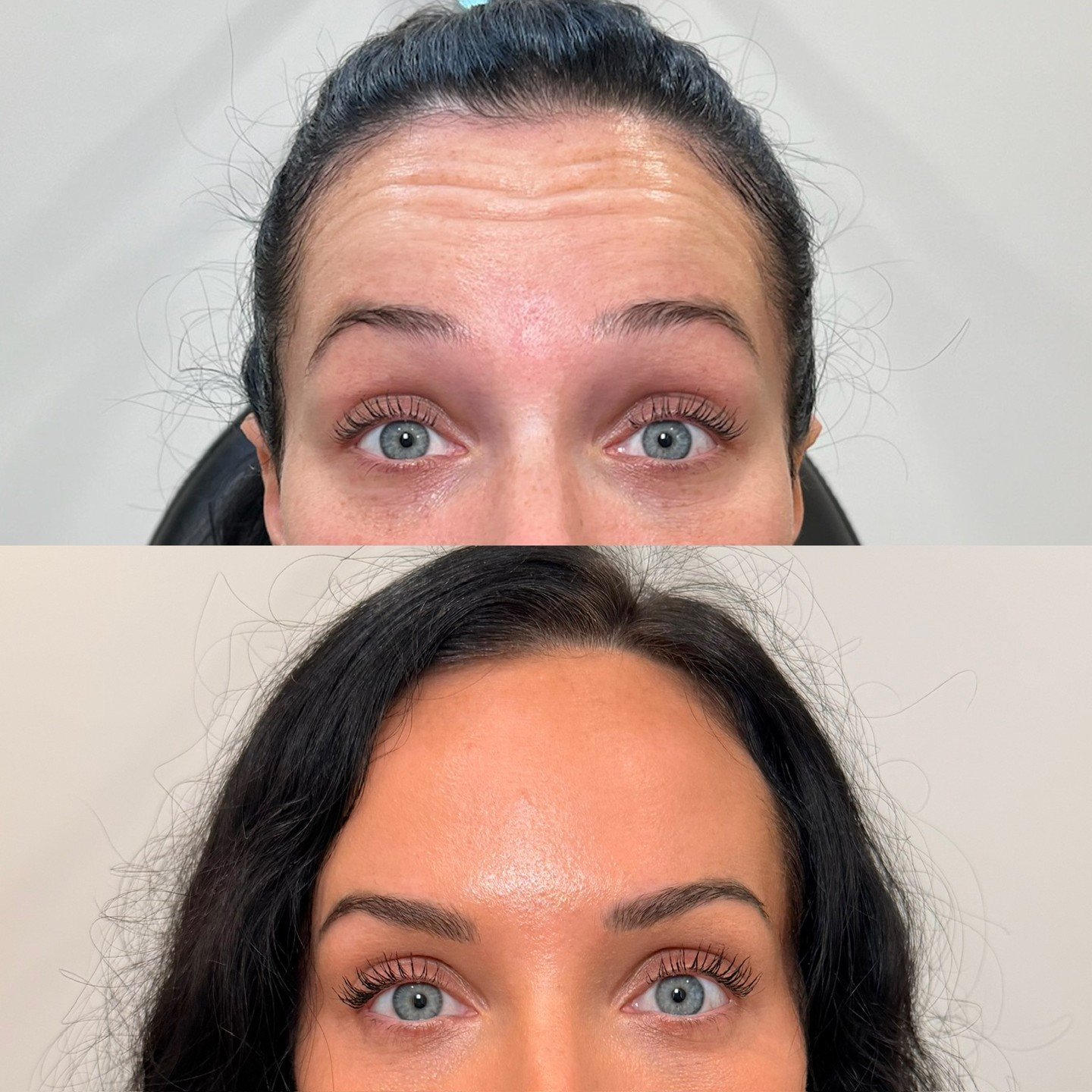 Results like these start with a personalized assessment! By evaluating muscle strength, movement patterns, and facial anatomy, we can customize dosing to achieve a refreshed, natural-looking result.

#botox #xeomin #wrinklerelaxer