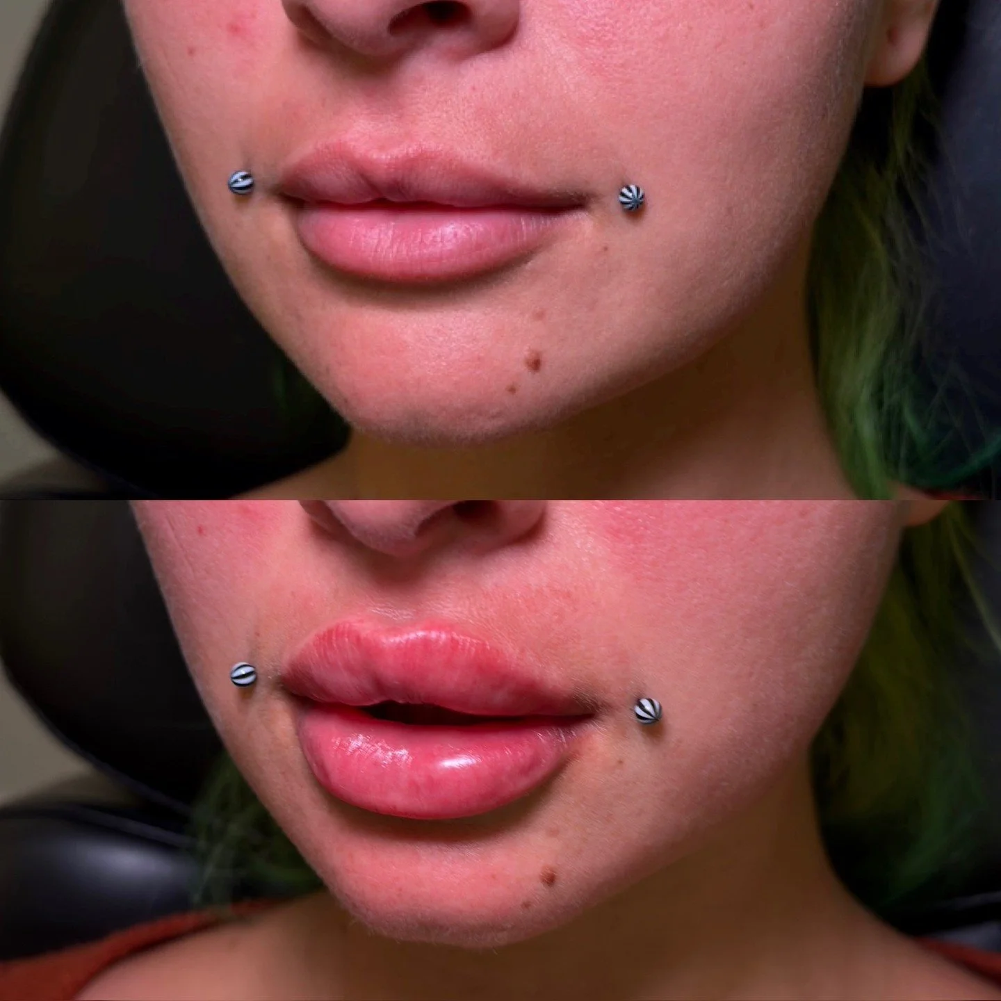 Patience is key when building your ideal lips

Our sweet patient initially came to us for her first session awhile back with Emma. She laid down a beautiful foundation of product from which we could continue sculpting and volumizing the shape she was