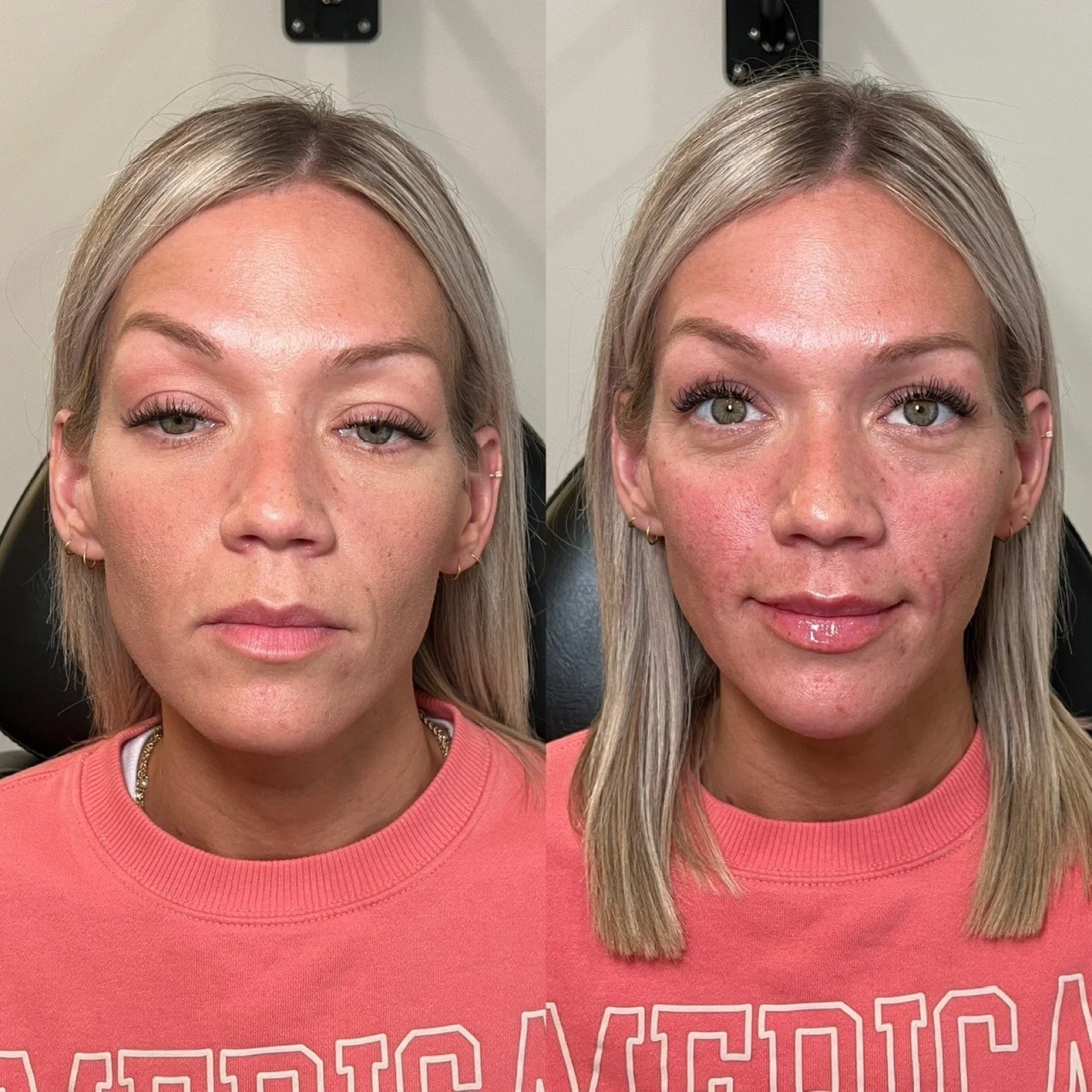 The type of Facial Balancing that remains undetectable, yet incredibly impactful. 

Areas Treated: 
- Midface 
- Chin 
- Smile Lines 
- Lips
- Upper Face Tox 

#facialbalancing #lipfiller #botox