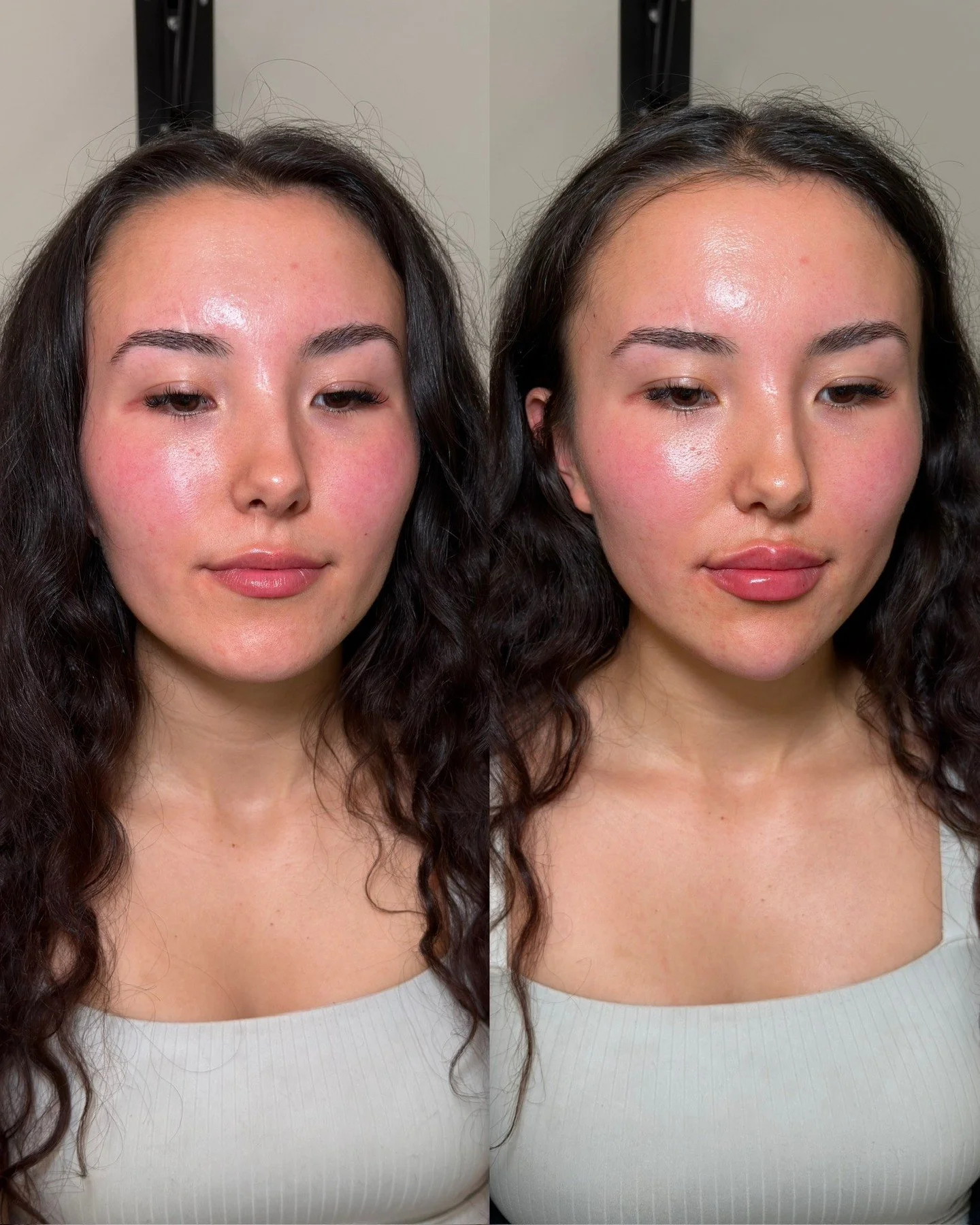 Noticeable but impactful results, always

My beautiful client had previously seen us for her initial session dedicated towards enhancing her lips and chin with Nina.

After waiting several months for her results to settle, she came to see me for a se