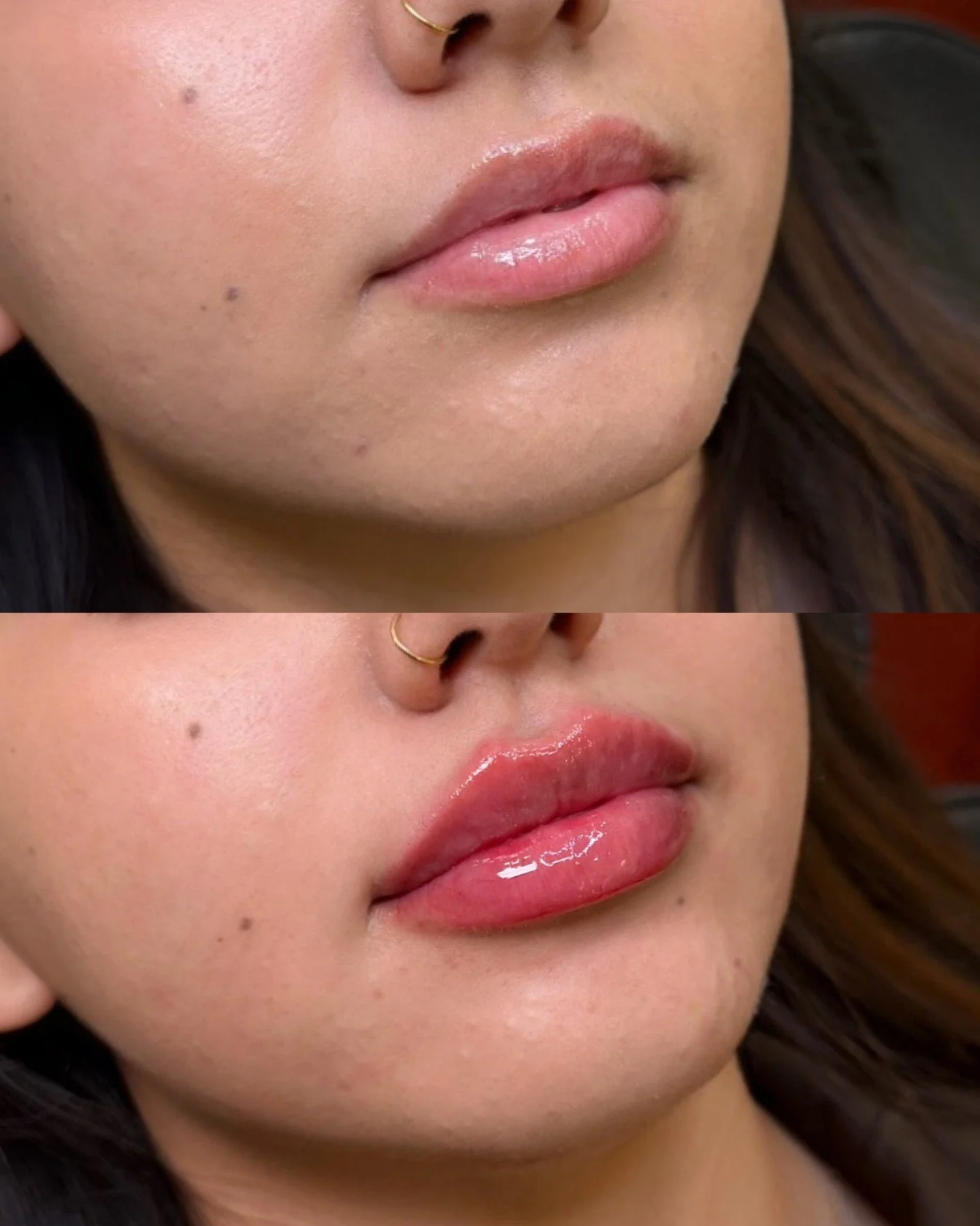 Lip journey with intentional rebuilding

After previously dissolving old product, we were able to rebuild her lips with a fresh, balanced approach focused on her ideal shape goals. This treatment emphasized a bow-shaped lip, defined Cupid&rsquo;s bow