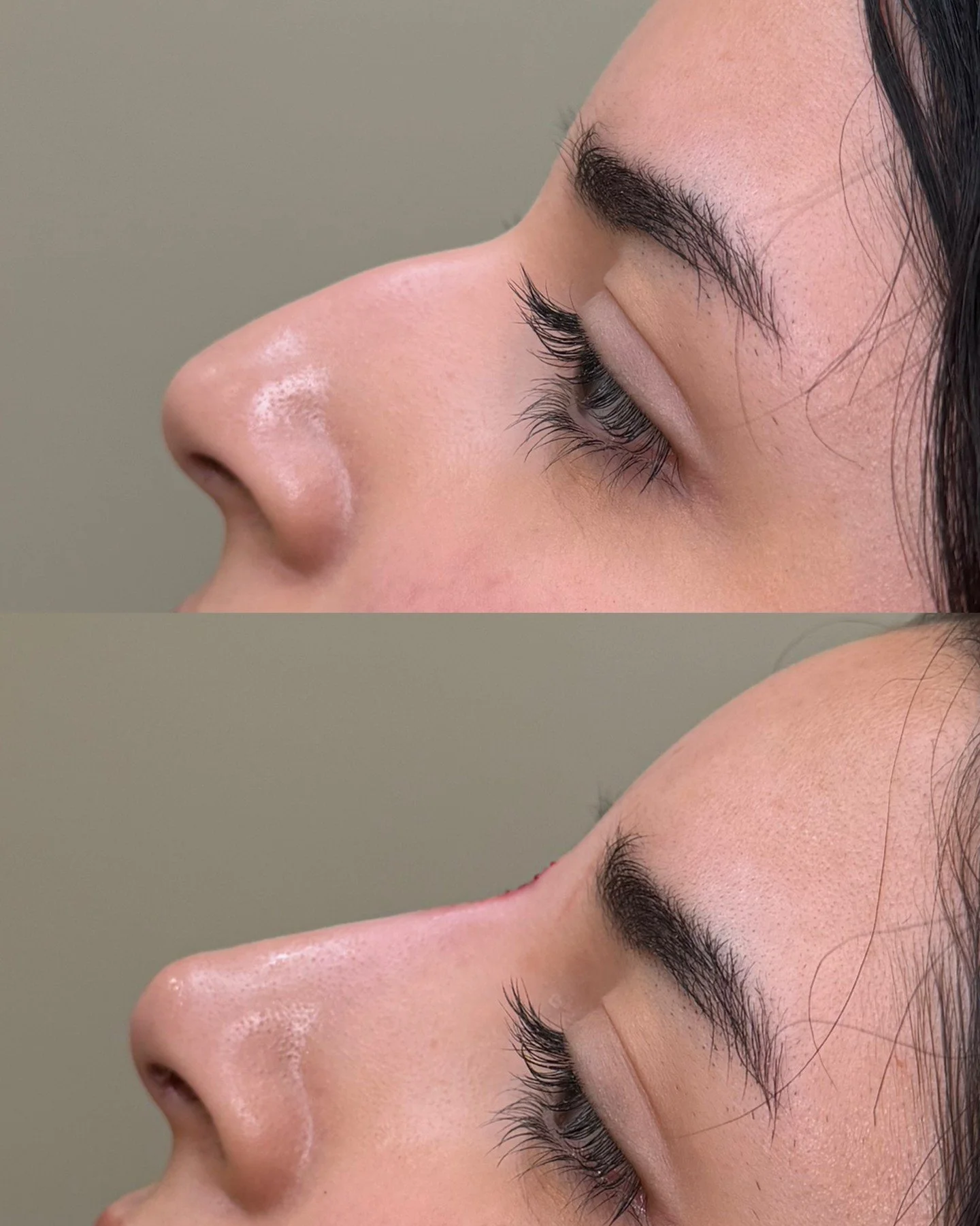 Liquid rhinoplasty for dorsal hump refinement

This treatment focused on blending the dorsal hump while creating a subtle lift through the tip for a smoother, more balanced profile. Strategic placement allowed us to soften irregularities and refine t