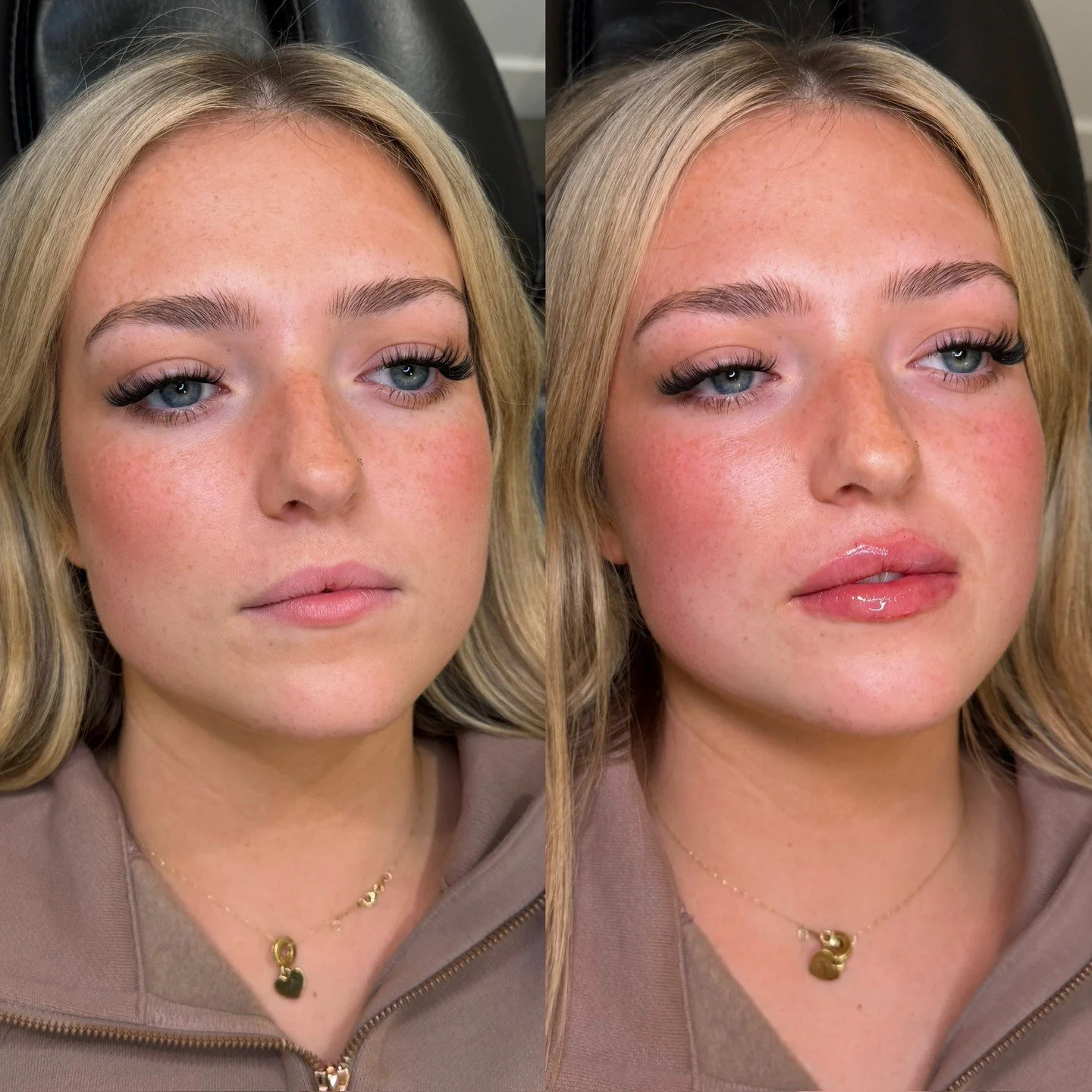 Lip enhancement 

This treatment focused on building structure and dimension in naturally flatter lips. By concentrating on central height and subtle volume through the middle, we were able to create a more lifted shape with a soft keyhole effect whi