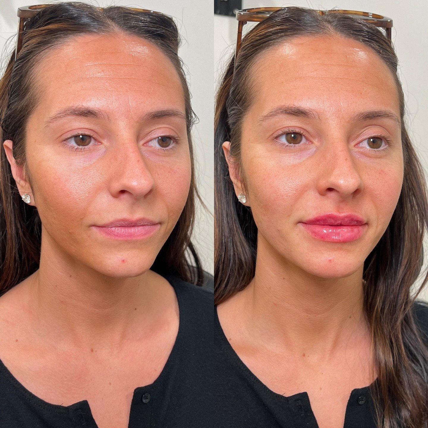 DISSOLVED ➡️ REFILLED with our Plump Classic Lip Technique 

After years and multiple sessions of filler, it&rsquo;s time to refresh! Dissolving is necessary throughout the years to maintain clean borders, and pronounced shape. 

 #lips ##lipfiller #