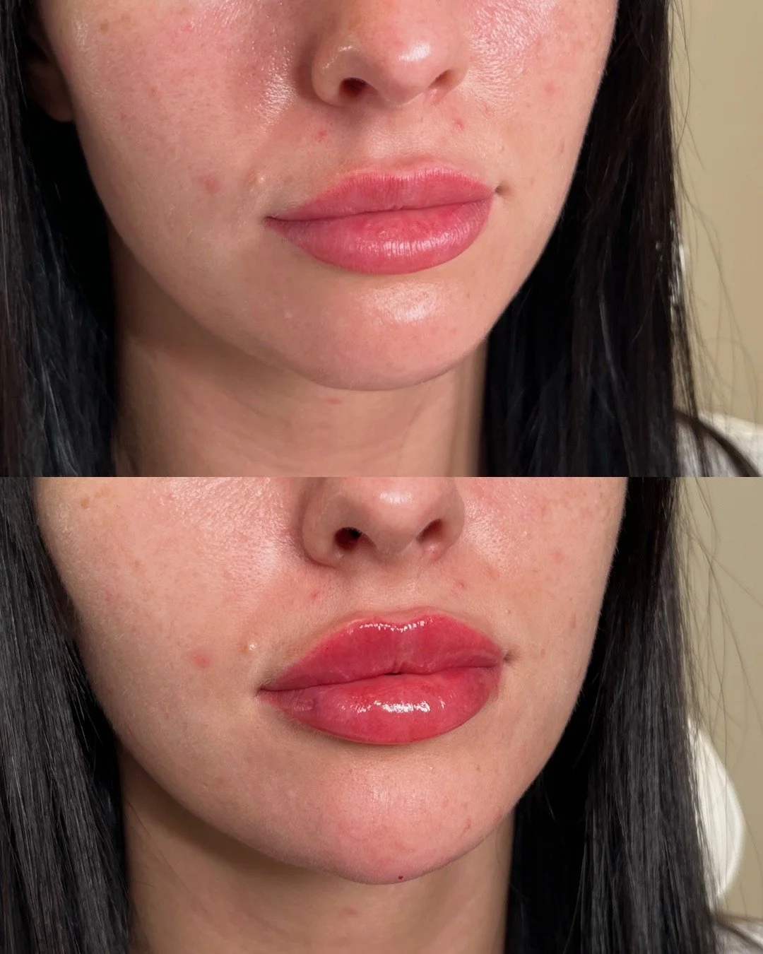 Soft natural lip filler results from Portland cosmetic injector