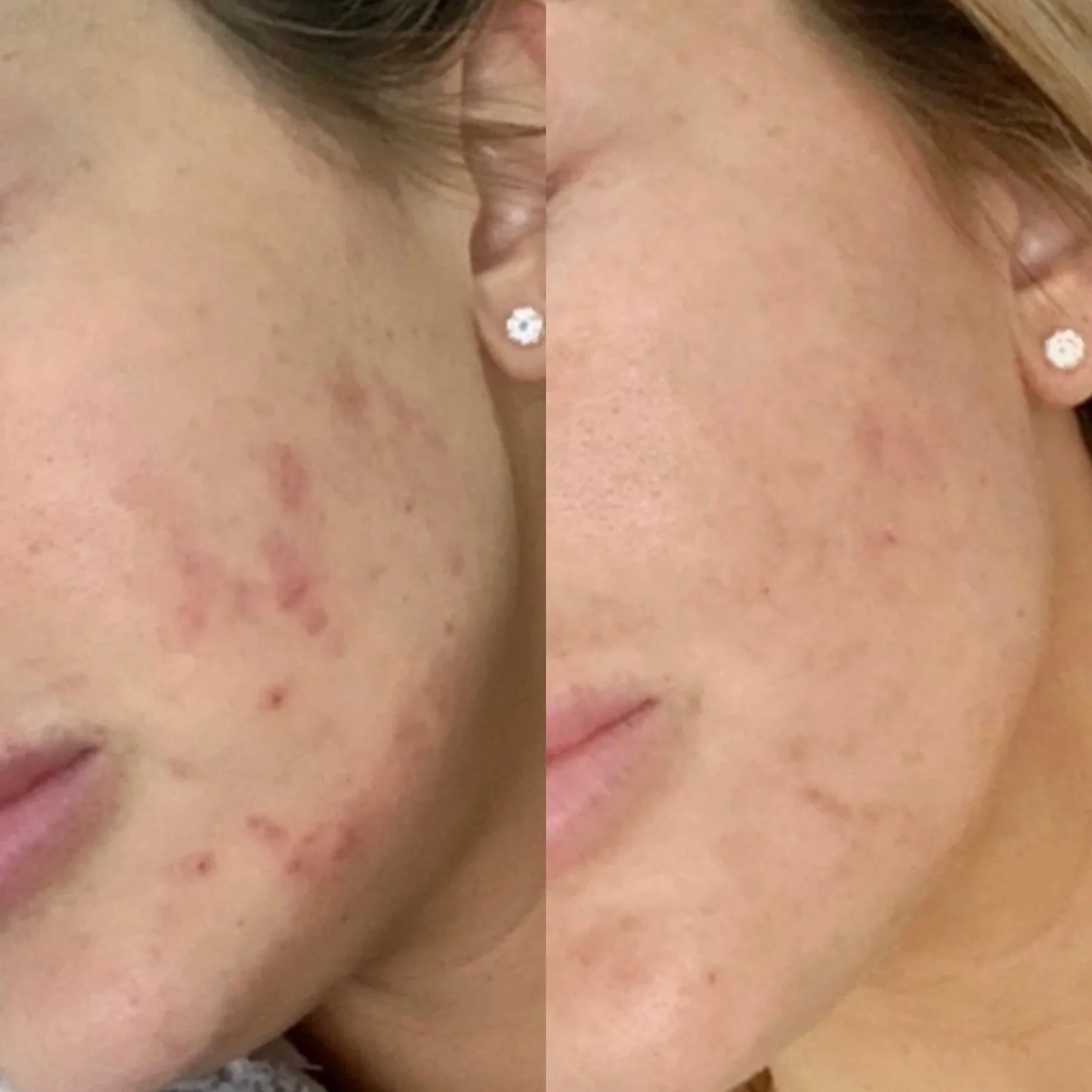 Close-up photo of a person's face showing redness and blemishes on the skin, with a focus on the cheek and ear area.