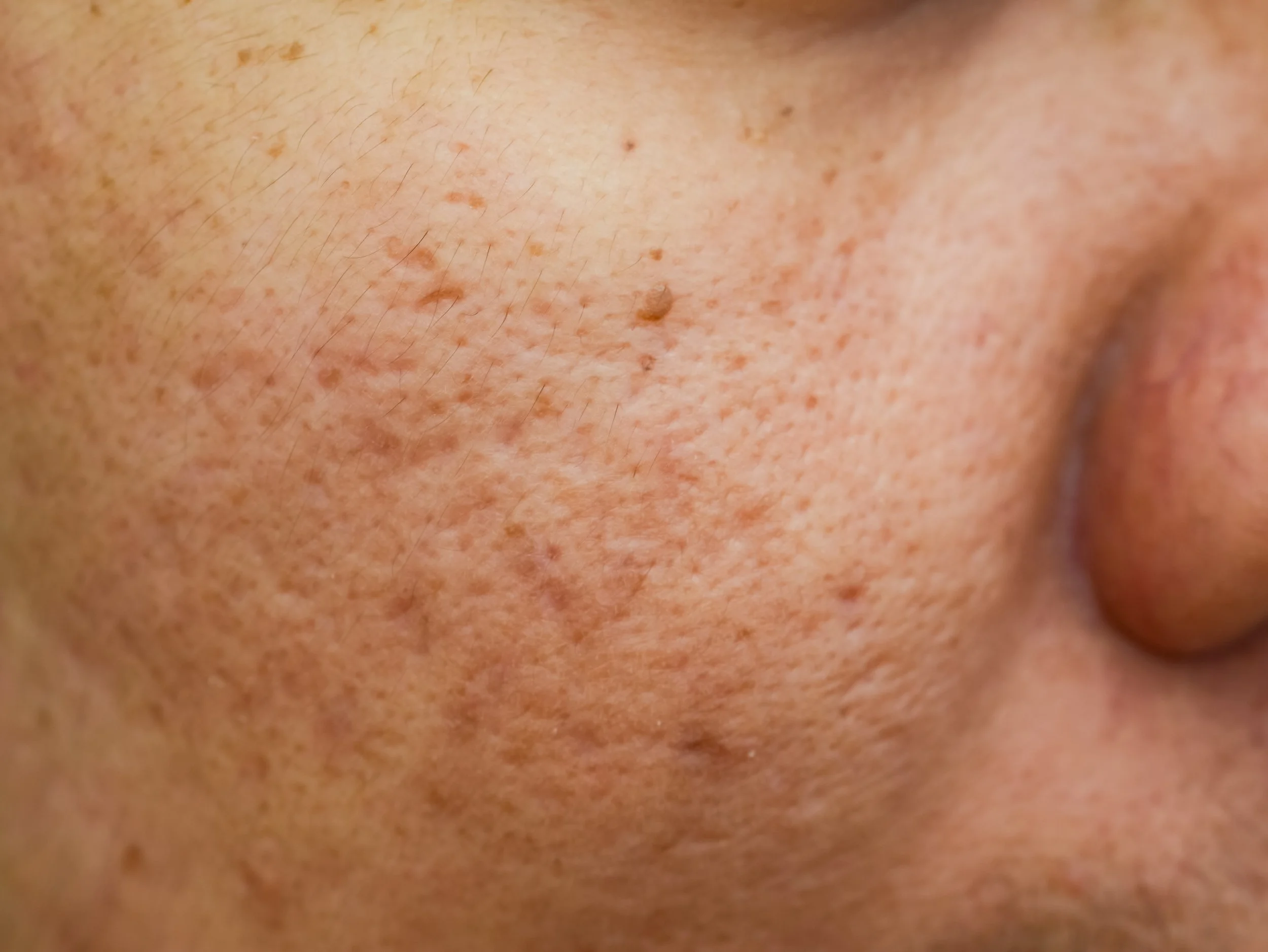 Close-up image of human skin showing freckles and pores.