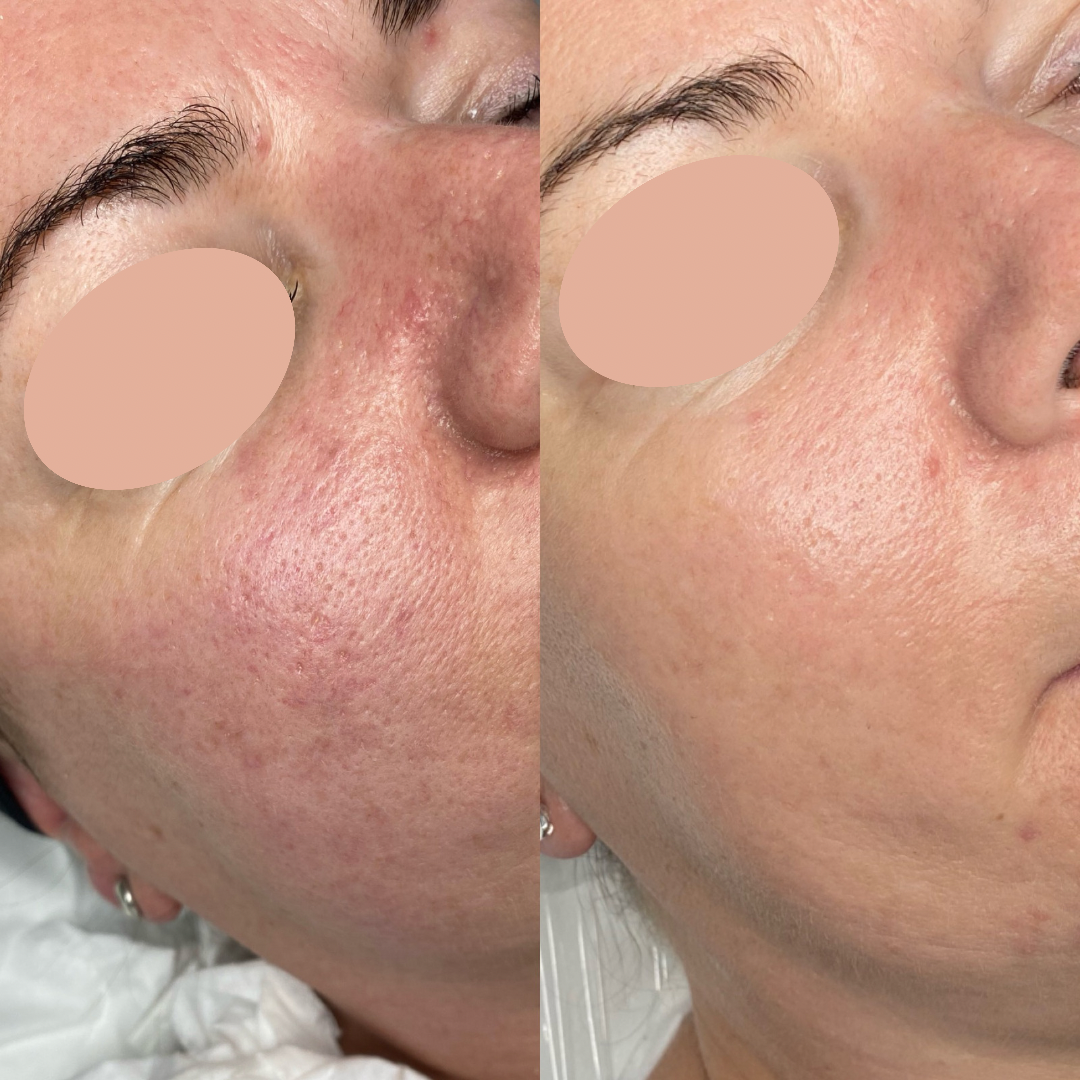 Close-up comparison of a person's cheek showing before and after facial skin treatment, highlighting reduced redness and improved skin texture.