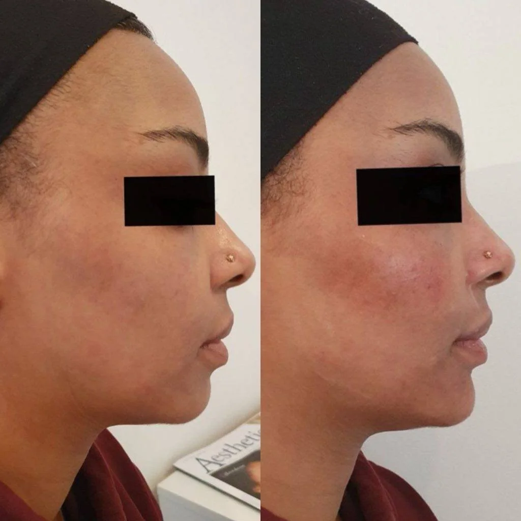 Side-by-side comparison of a woman's face before and after skin treatment, showing improved skin texture and redness reduction.