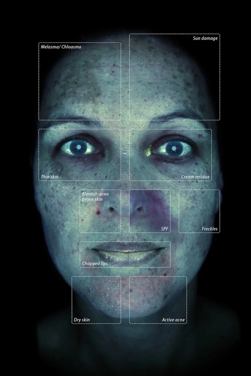 Close-up of a person's face with multiple skin concerns labeled, including Melasma/Chloasma on the forehead, sun damage, thin skin, cream residue, blemish-acne prone skin, SPF, freckles, chapped lips, dry skin, and active acne.