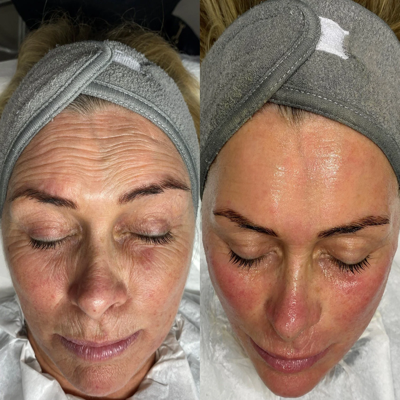 Before and after images of a woman's face showing skin improvements, with the first image displaying wrinkles and uneven skin tone, and the second image showing smoother, brighter skin.