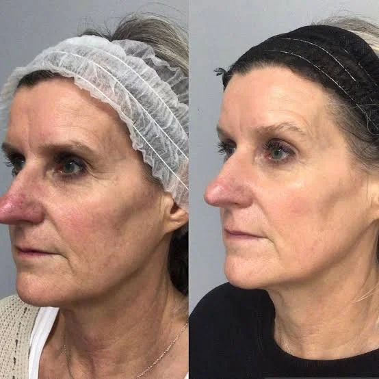Side-by-side comparison of a woman's face before and after cosmetic treatment, with the before image showing her wearing a disposable hair cap.