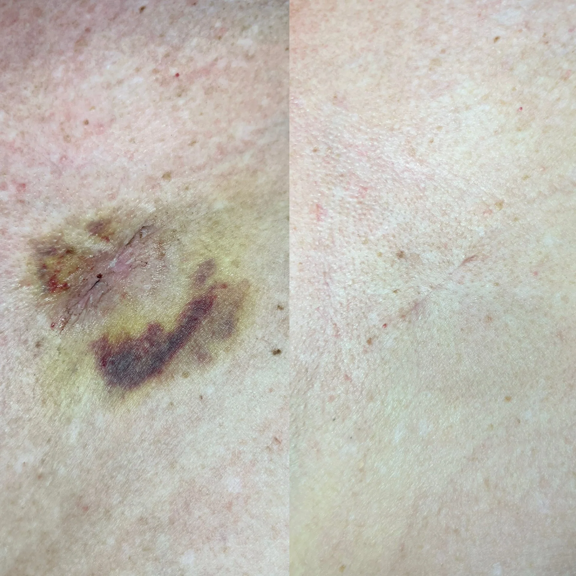 A close-up of a person's facial skin showing age spots, redness, and uneven texture, with a comparison of skin clarity on the right side.