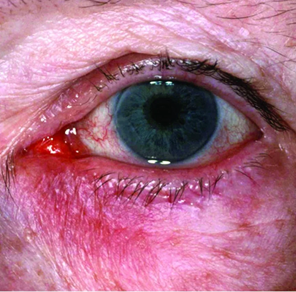 Close-up of a human eye with a red irritated area beneath the lower eyelid.