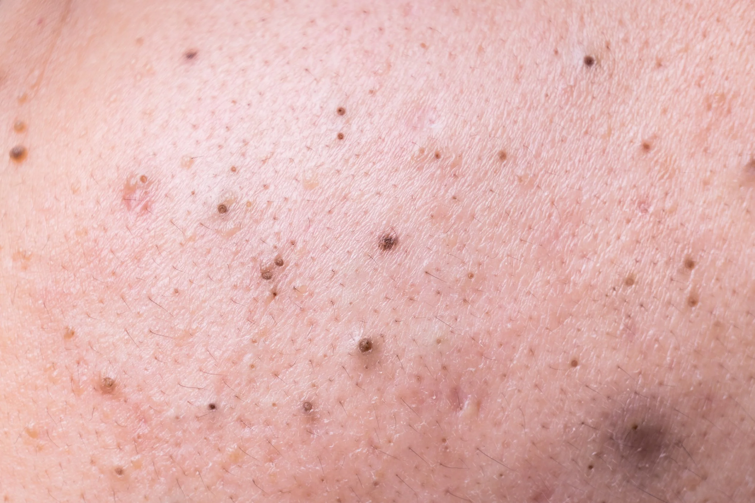 Close-up image of human skin with several moles or beauty marks of varying sizes.