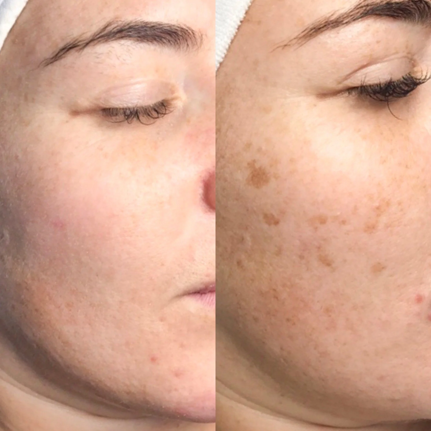 A side-by-side comparison of a person's face, showing the left side before and after cosmetic or skincare treatment, focusing on the eye, eyebrow, and cheek areas.