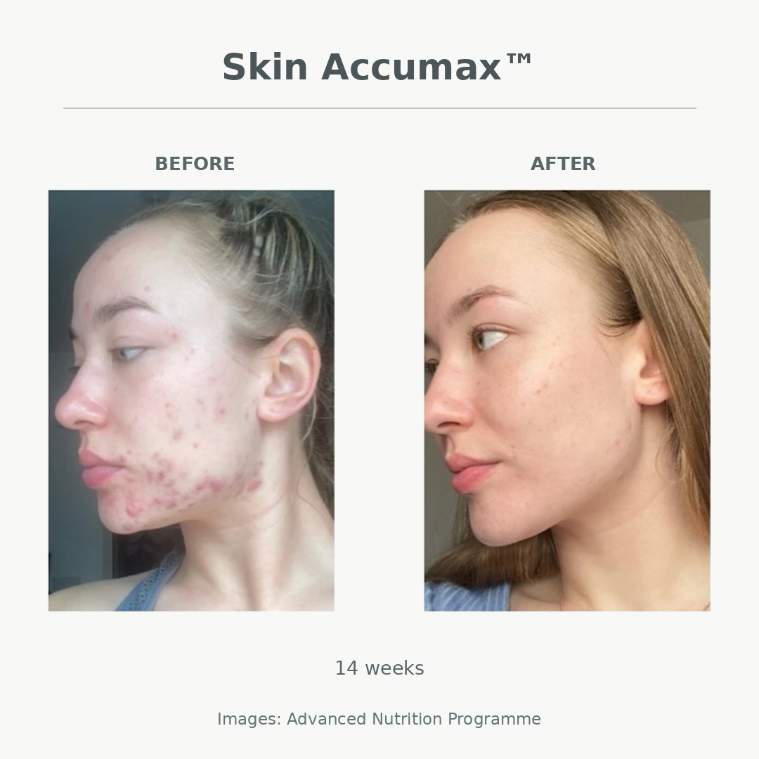 Side-by-side comparison of a woman's face before and after cosmetic treatment, showing improved skin appearance.