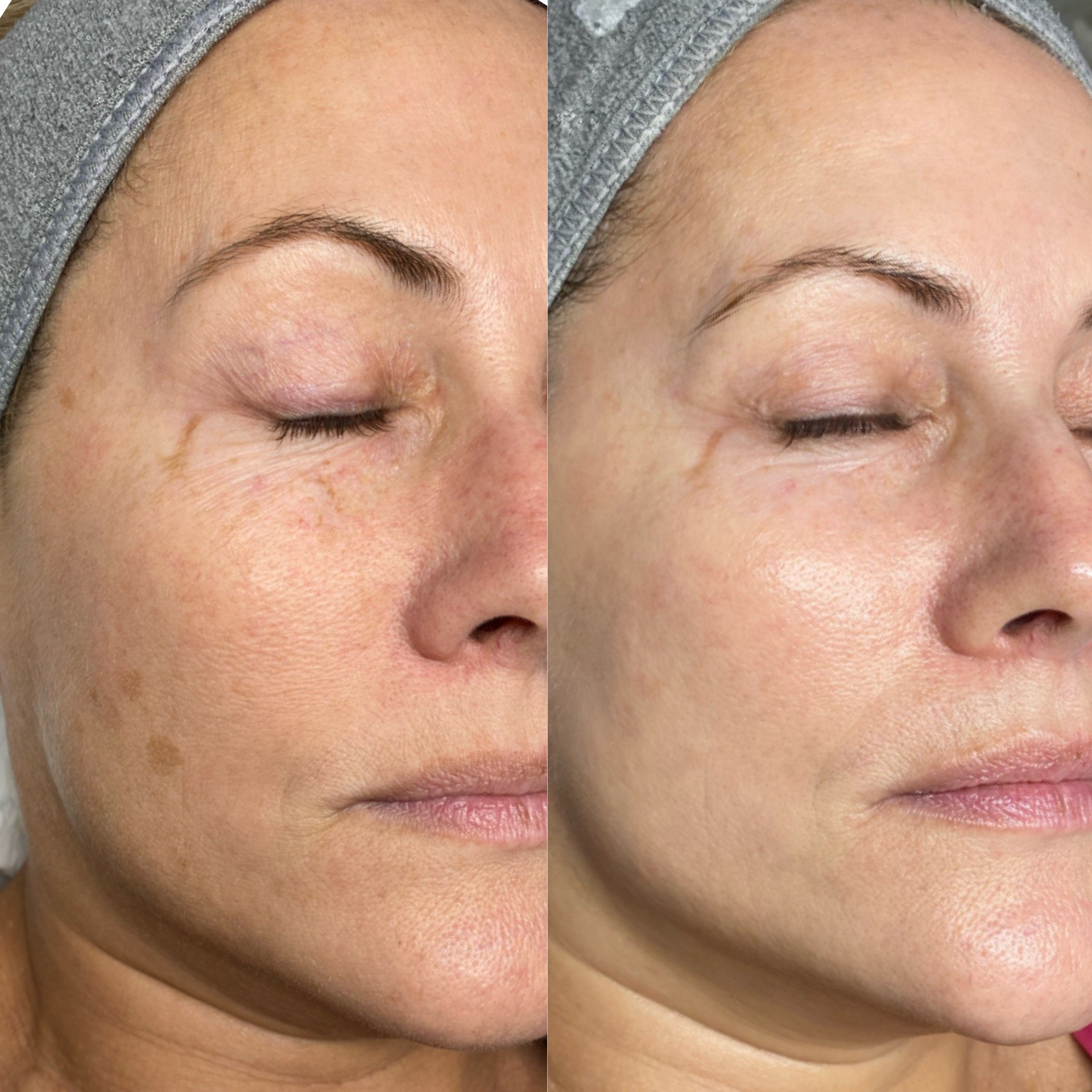 Close-up of a woman's face showing before and after comparison of skin appearance, focusing on cheek area, with smoothened skin on the right.