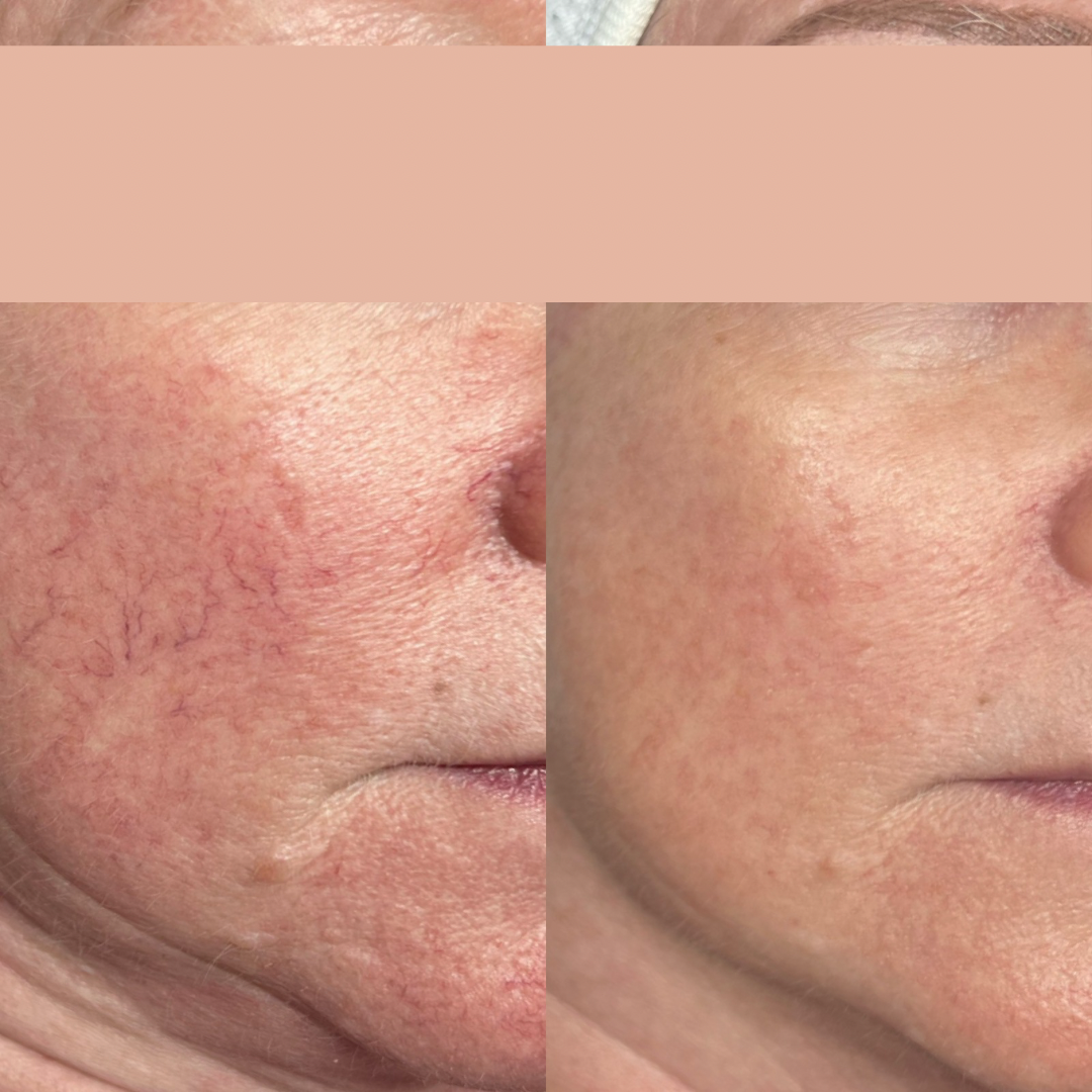 Close-up comparison of skin showing significant reduction in redness and visible blood vessels, likely after skincare treatment.