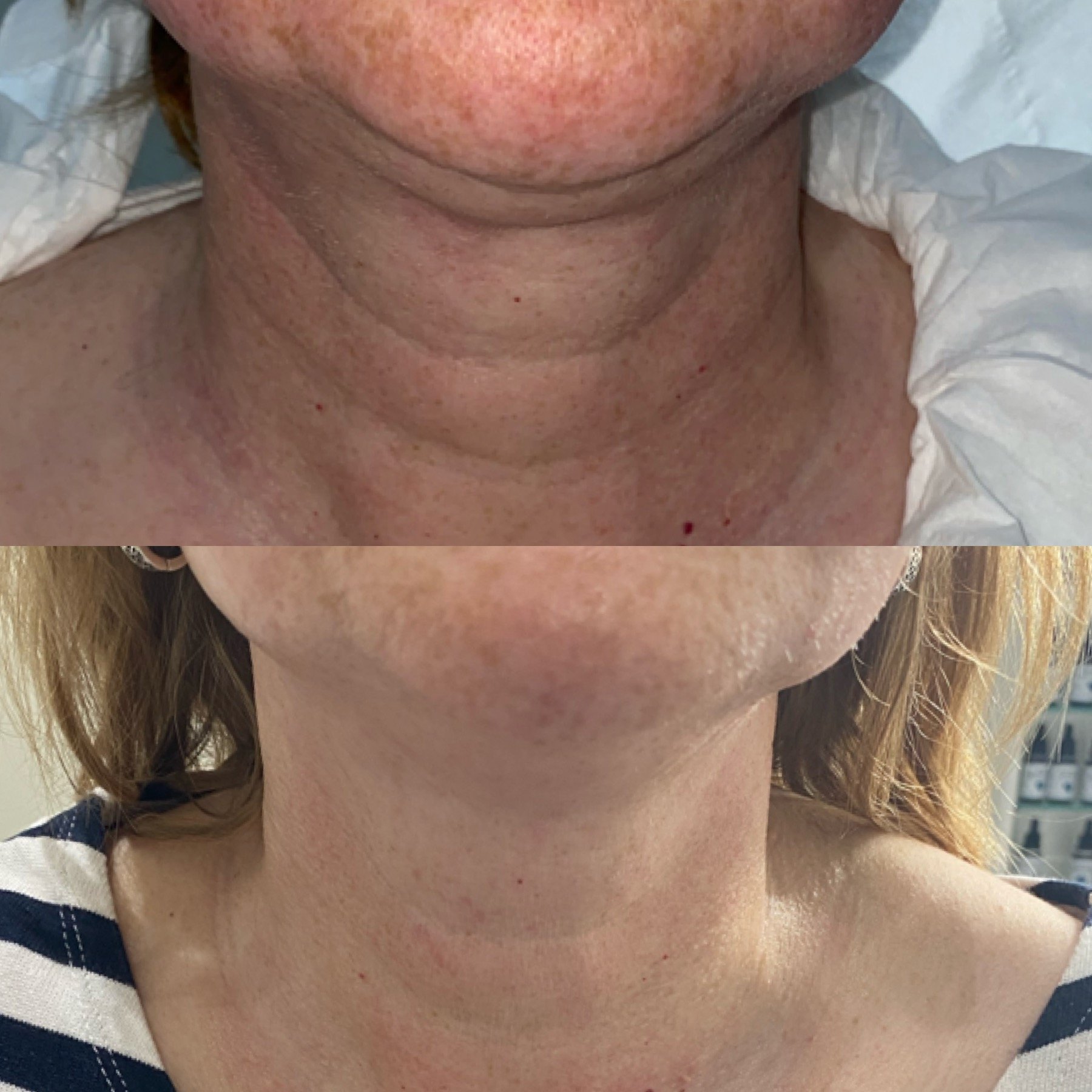 Close-up of a person's neck and lower face, showing skin texture, freckles, and some redness.