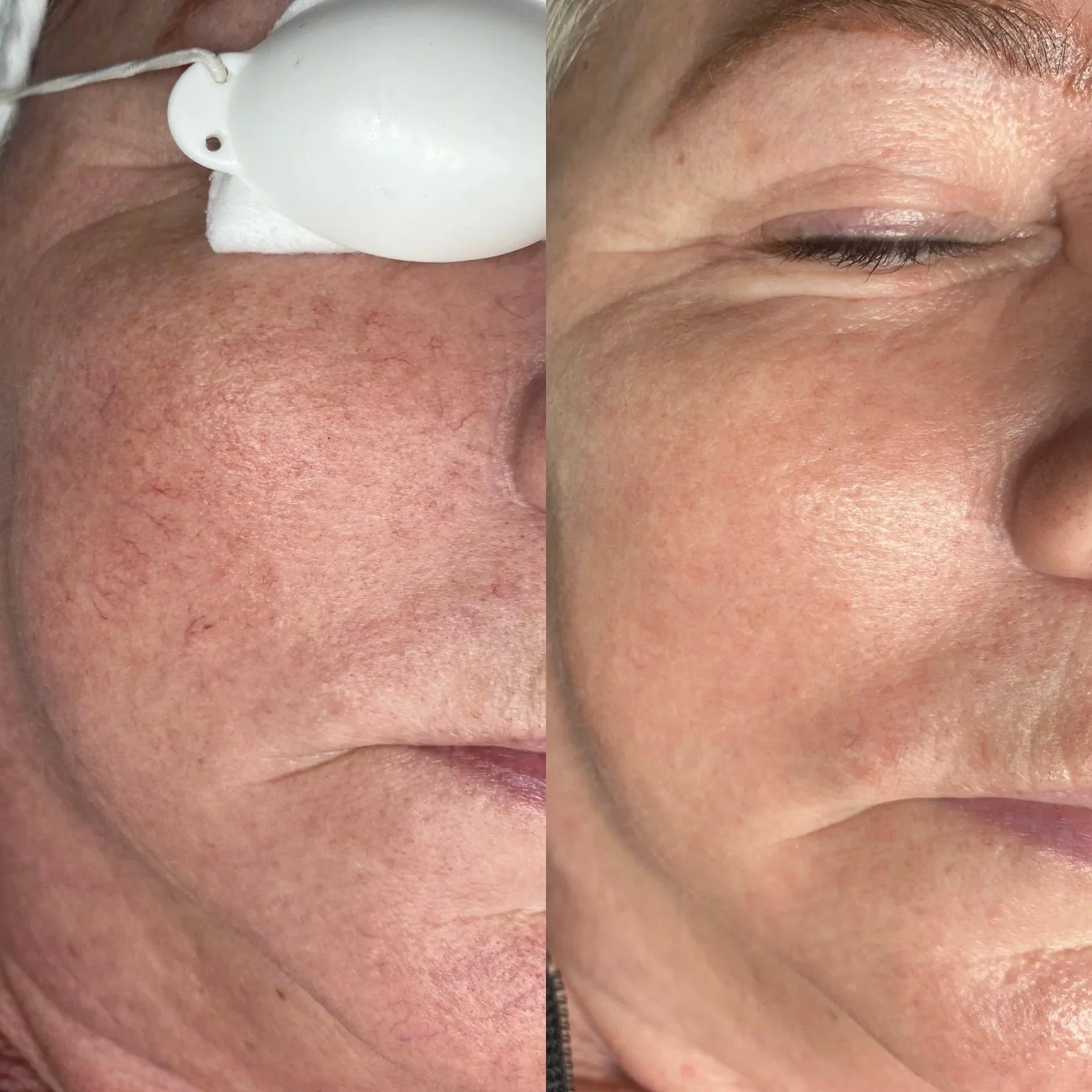 Close-up of a person's face showing the left cheek and eye, with a medical device on the nose, and the right cheek appearing smooth and clear.