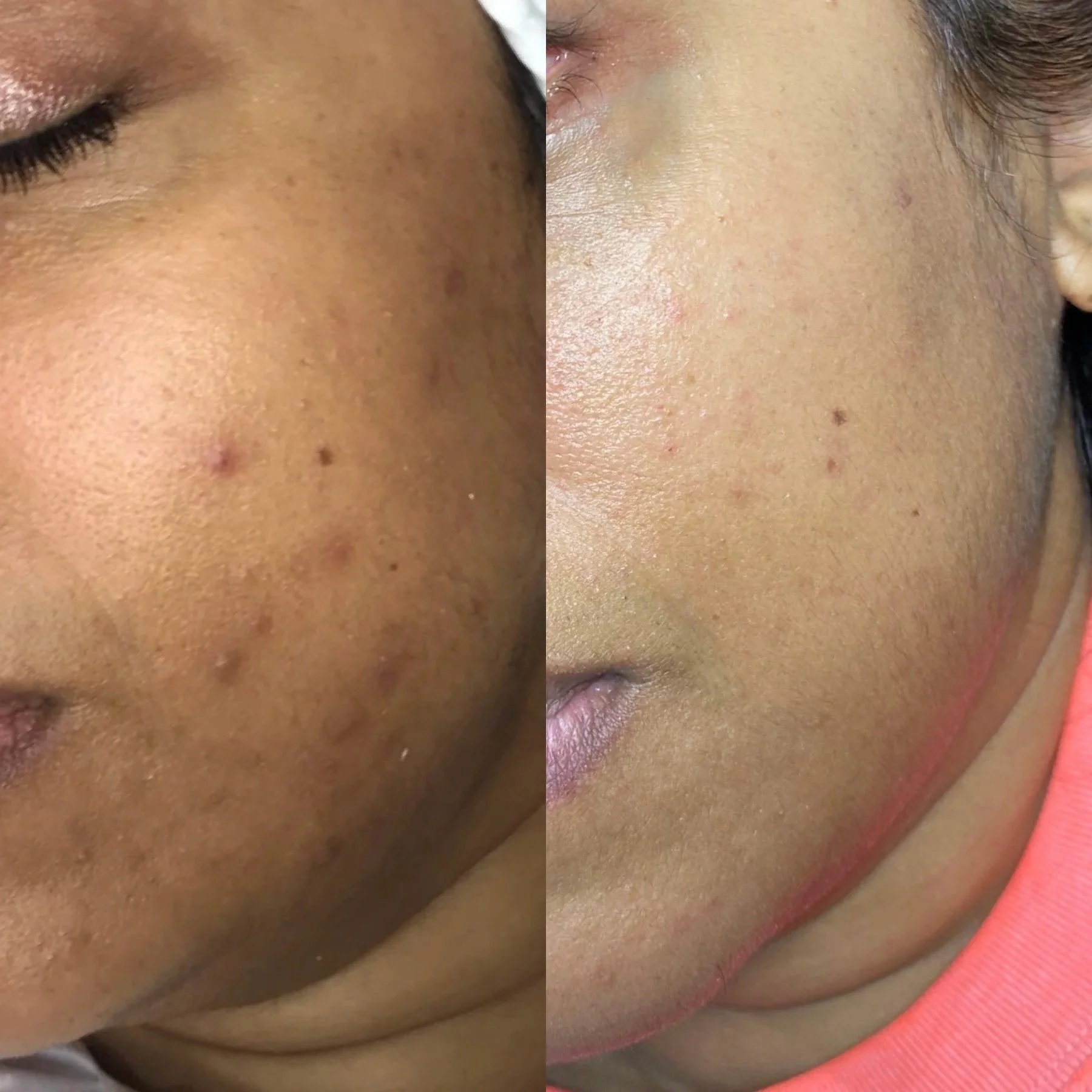 Close-up of a person's cheek showing dark spots and acne scars on the left, with clearer skin and fewer spots on the right.