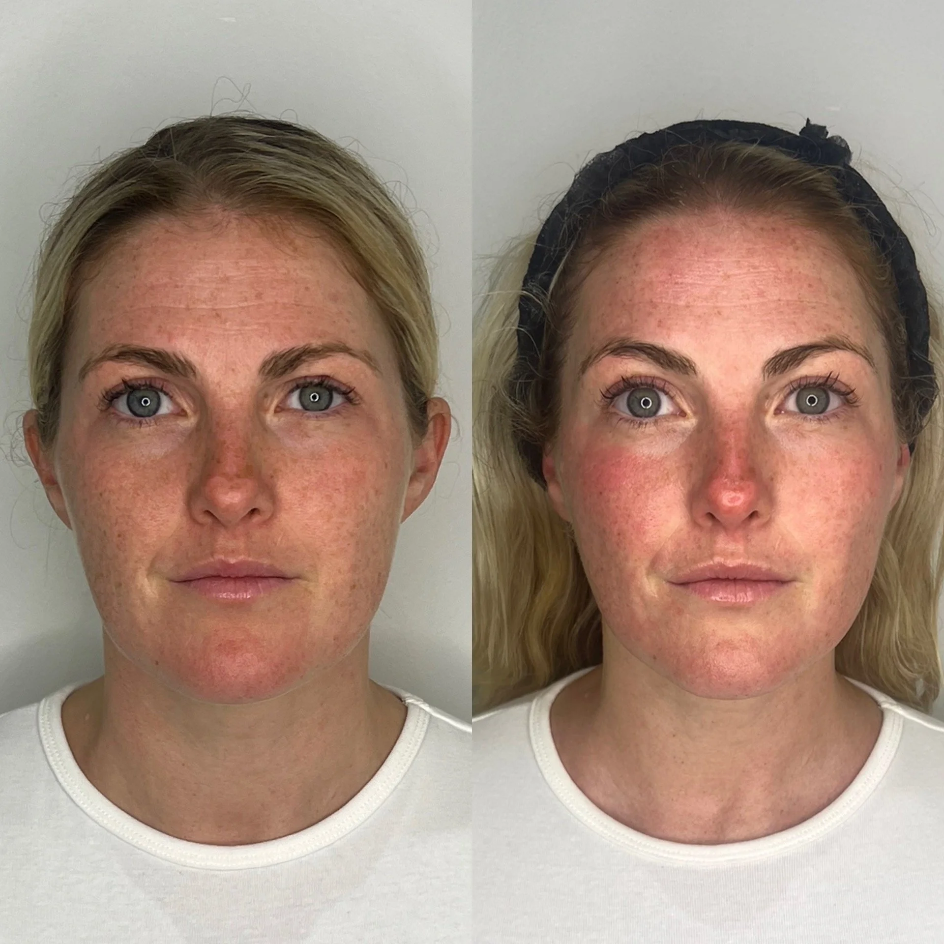 Comparison of before and after facial skin treatment, showing improved brightness and reduced redness on woman's face.