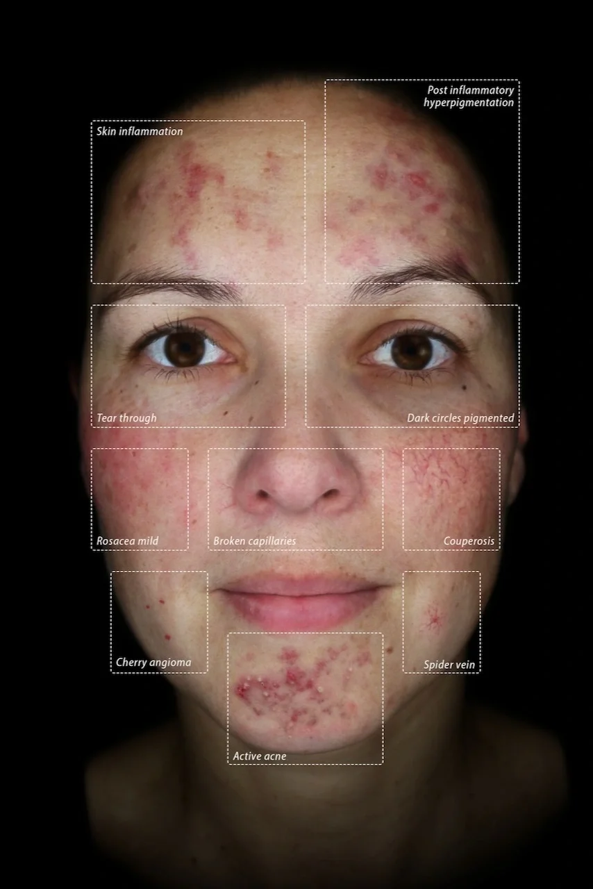 Close-up of a woman's face showing various skin issues, including inflammation, hyperpigmentation, tear troughs, pigmented dark circles, mild rosacea, broken capillaries, couperosis, cherry angioma, active acne, and spider veins.