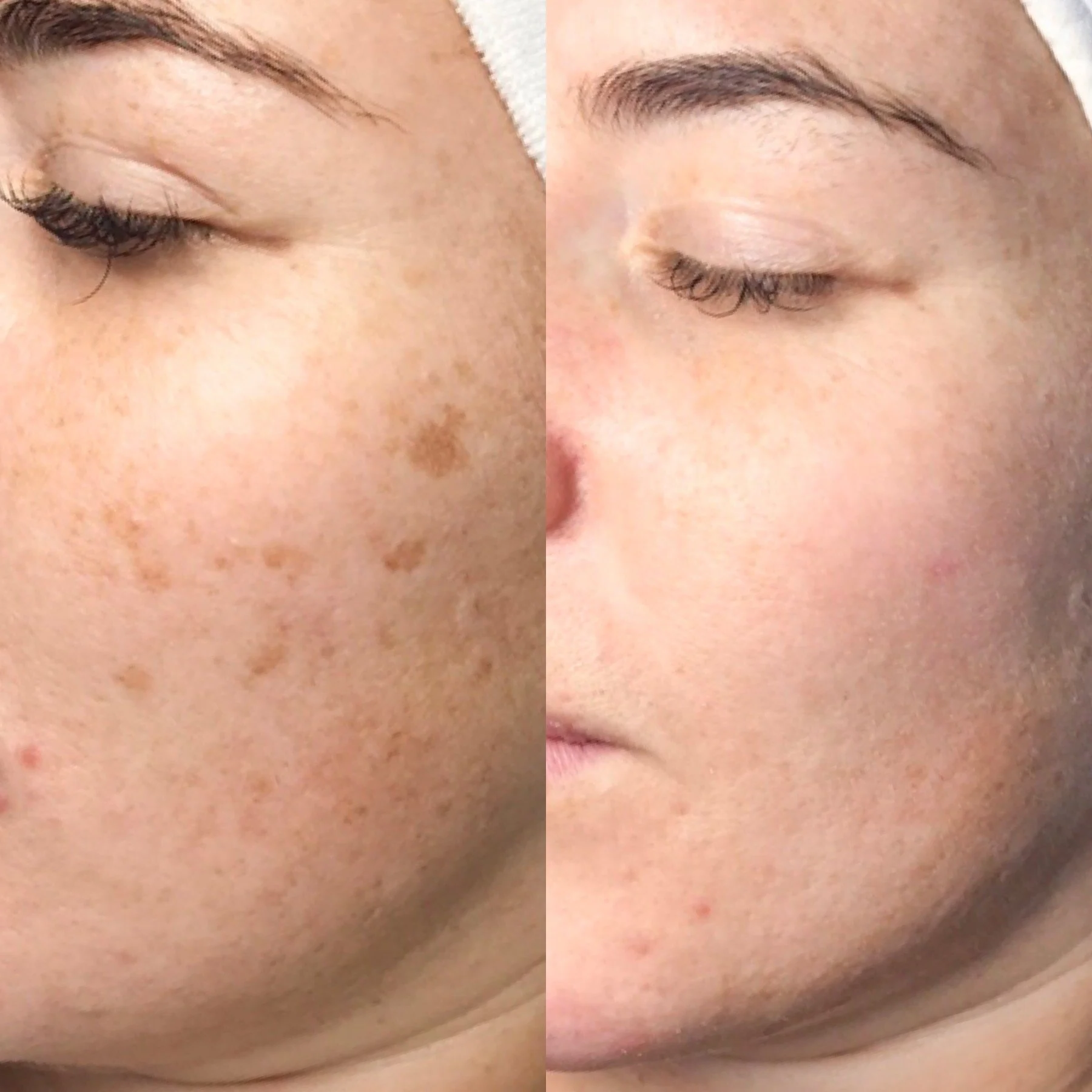 Close-up of a before and after comparison of a person's face showing significant reduction in freckles and dark spots.