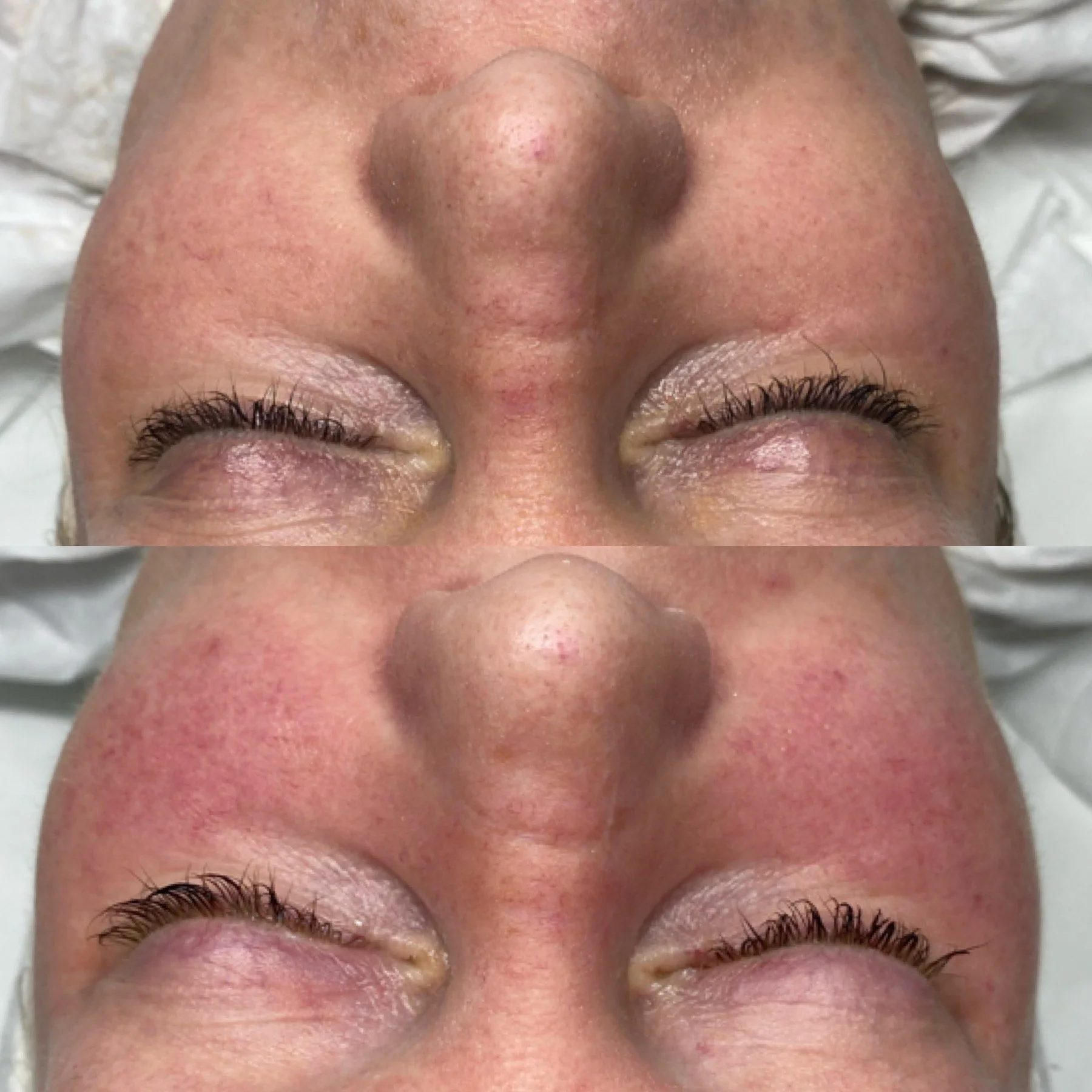 Close-up of a person's face showing a prominent nose, closed eyes, and skin with slight redness and small blemishes.