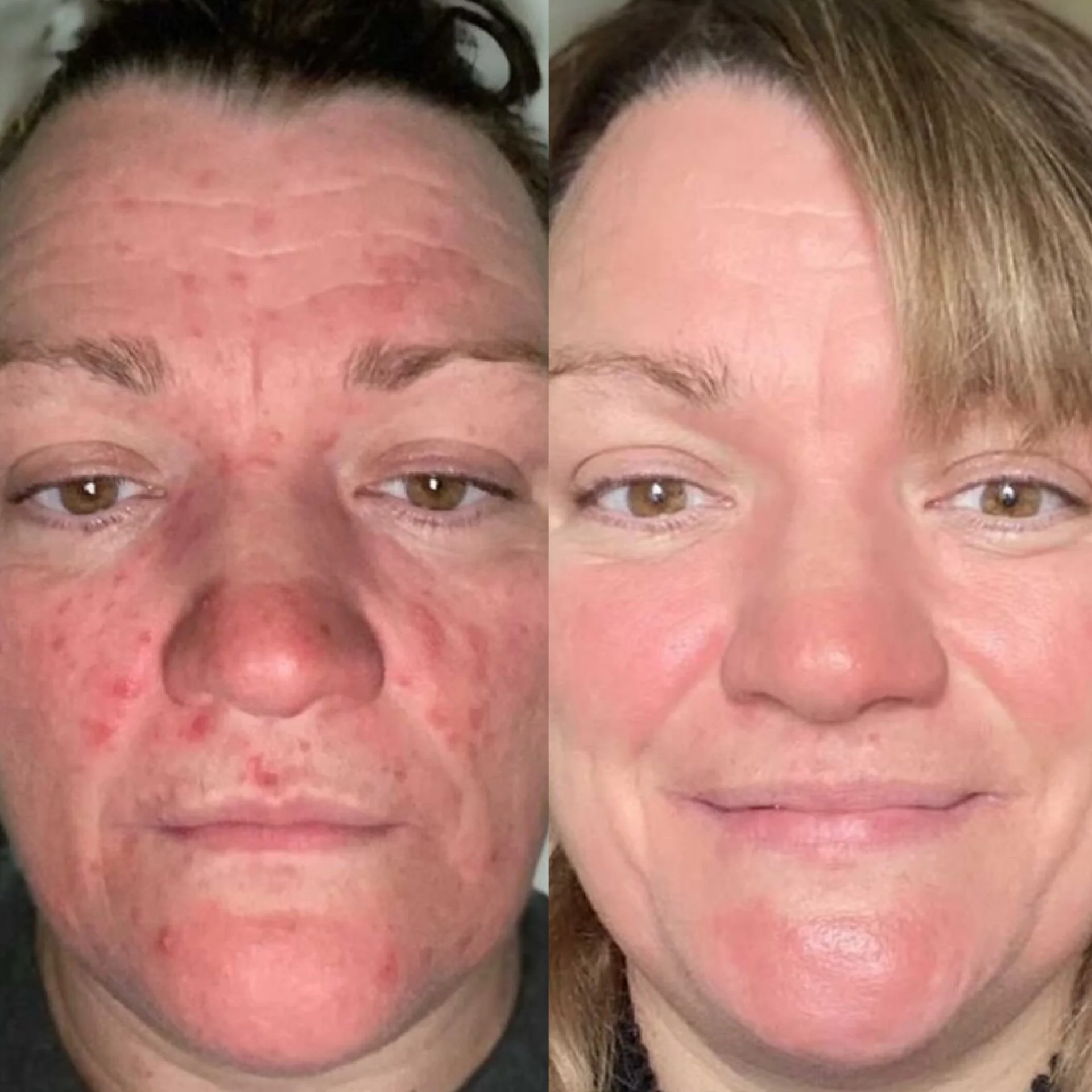 A side-by-side comparison of a woman's face before and after skincare treatment. The left shows red, irritated skin with uneven texture, while the right shows clear, smooth skin with an even tone and healthy appearance.