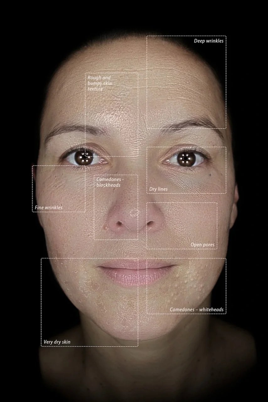 Close-up of a woman's face with skin issues labeled, including deep wrinkles, rough and bumpy skin texture, fine wrinkles, comedones, blackheads, dry lines, open pores, whiteheads, and very dry skin.