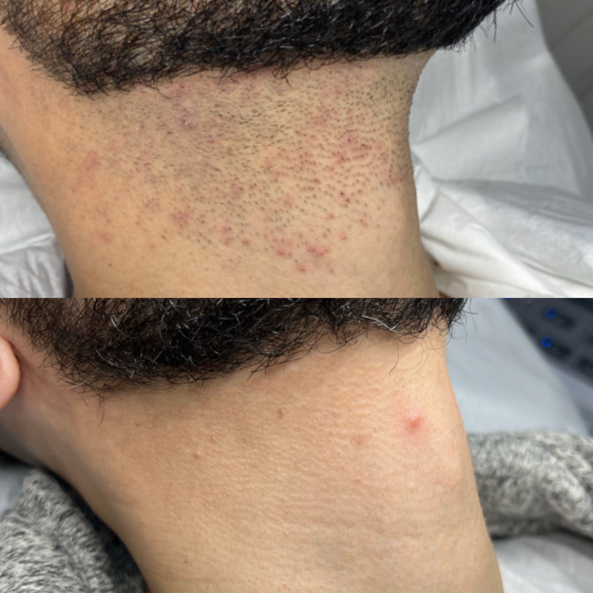 Close-up of a person’s skin with small red bumps and acne scars on the neck area.