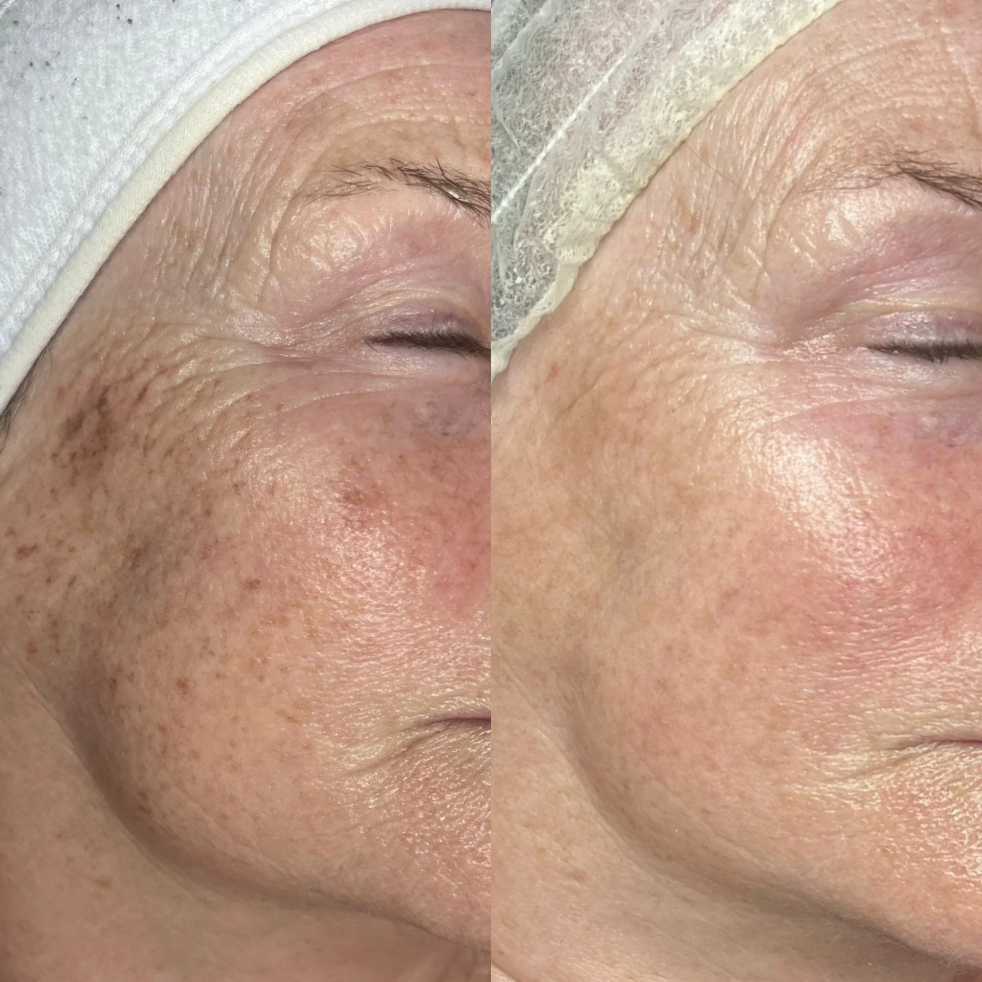 Close-up image of a person's closed eye with visible eyelashes, eyebrow, and skin texture, with a white towel or cloth partially covering the forehead.