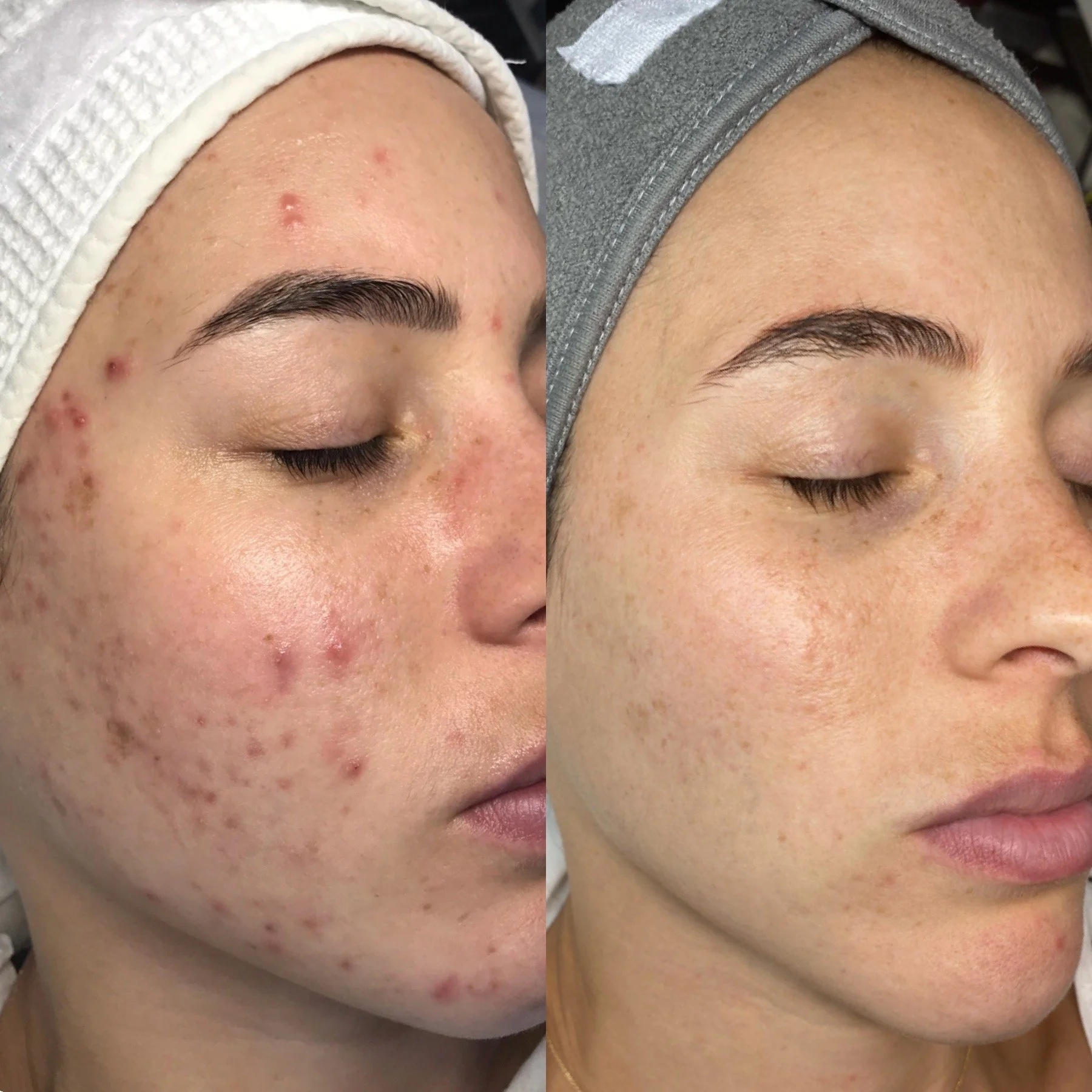 Side-by-side comparison of a woman's face before and after skin treatment, showing clear skin and reduced acne.