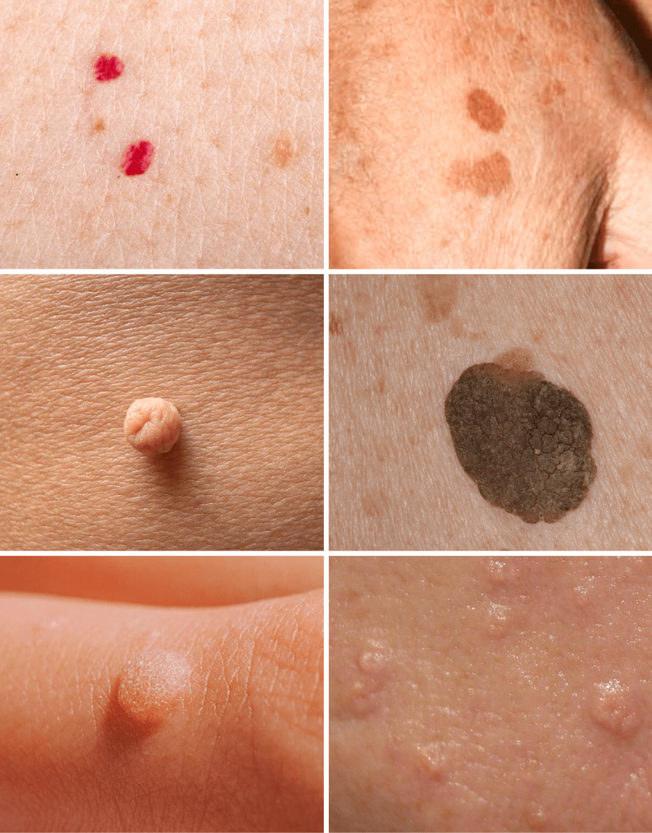 Close-up of various skin moles and skin tags of different shapes, sizes, and colors on human skin.