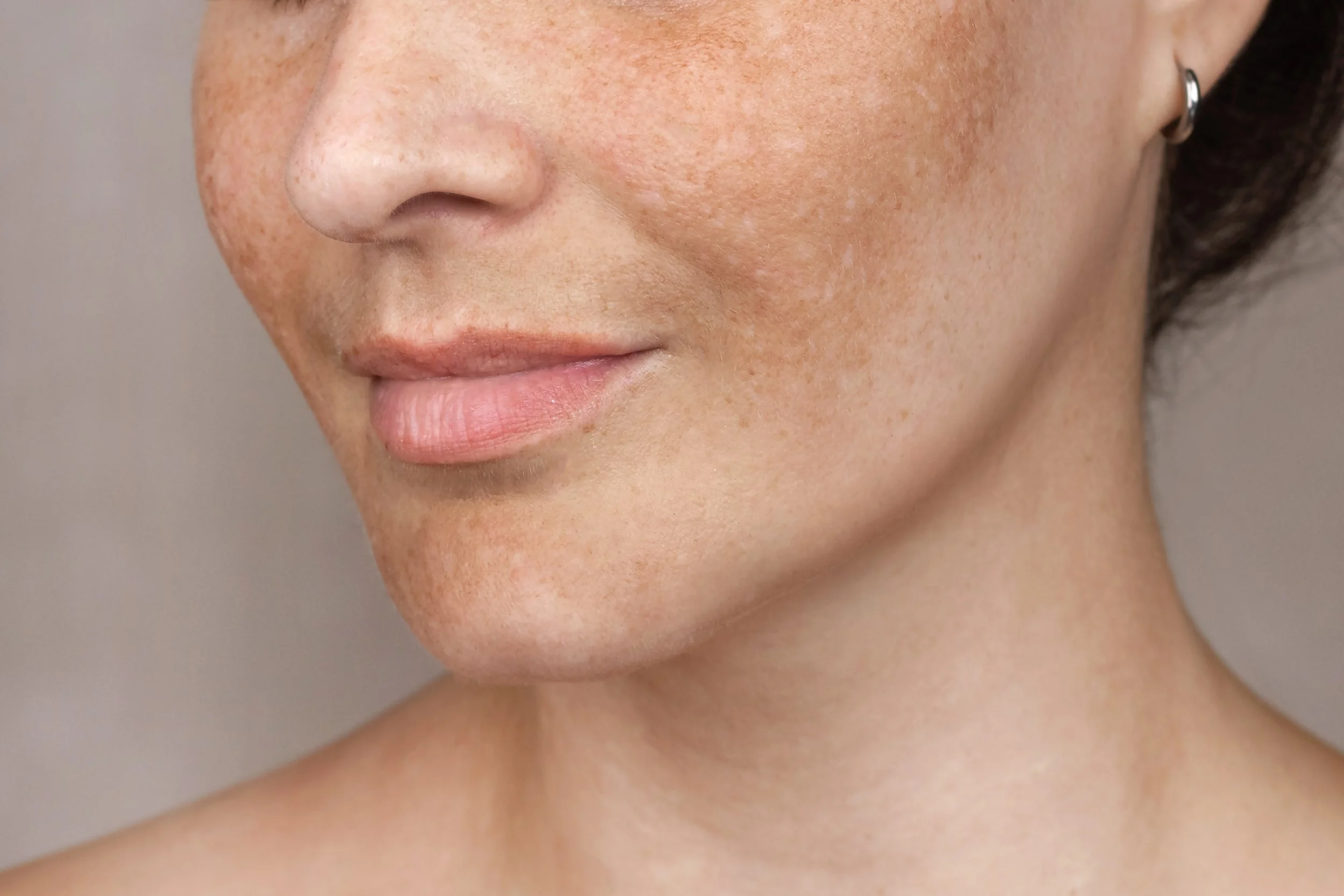 Close-up of a woman's lower face showing skin with freckles, a nose, and lips, with a partial view of an earring.