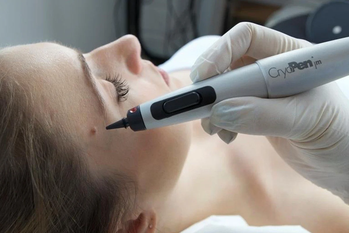 A person receiving a laser skin treatment with a CyoPen device, with a healthcare professional wearing gloves.