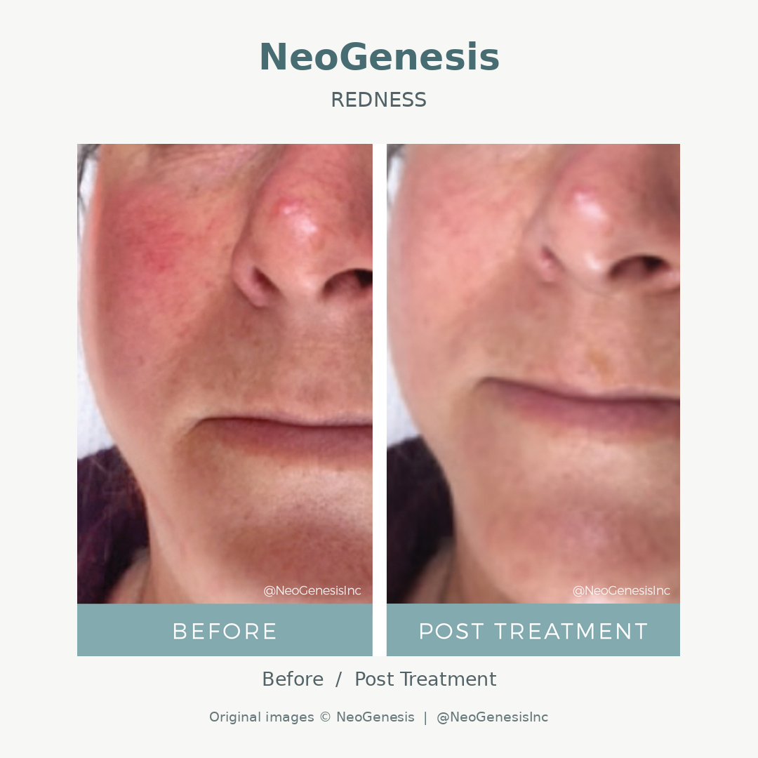 Side-by-side comparison of a woman's face before and after cosmetic treatment or skincare, showing improvements in skin texture and appearance.