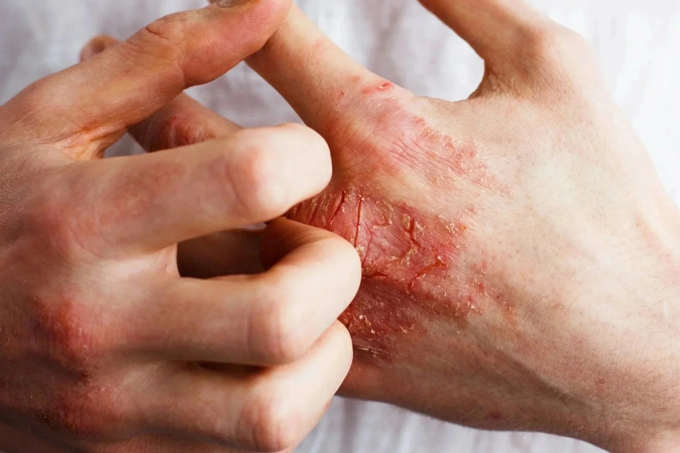 A person scratching red, irritated skin on their hand with their finger.