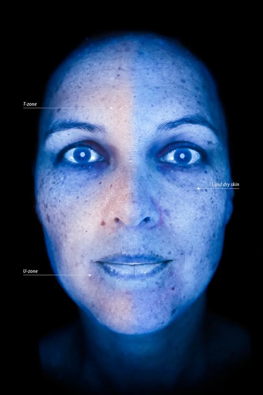 Close-up of a person's face with annotations indicating the T-zone, U-zone, and lipid dry skin, illuminated with blue light.