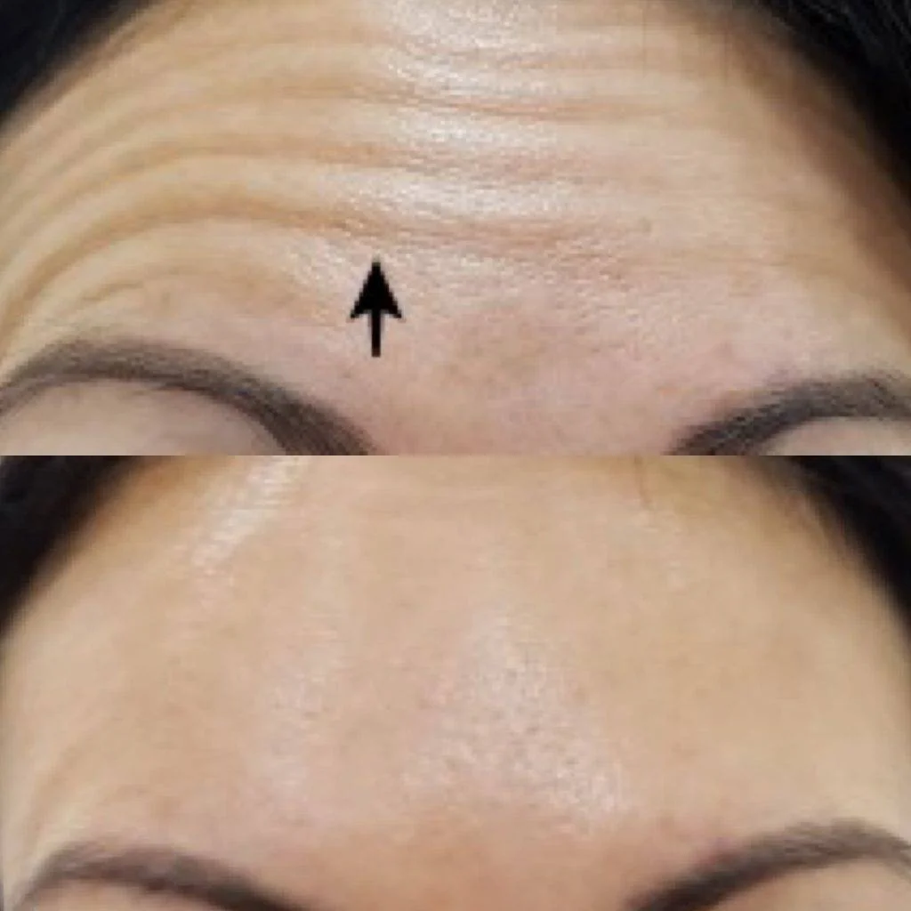 Close-up of a person's forehead with visible wrinkles and an arrow pointing to the wrinkles.