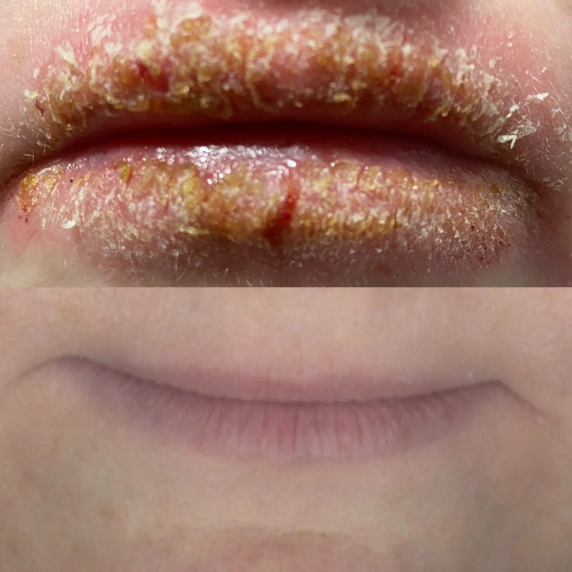 Close-up of a person's lips with dry, chapped skin and peeling patches.