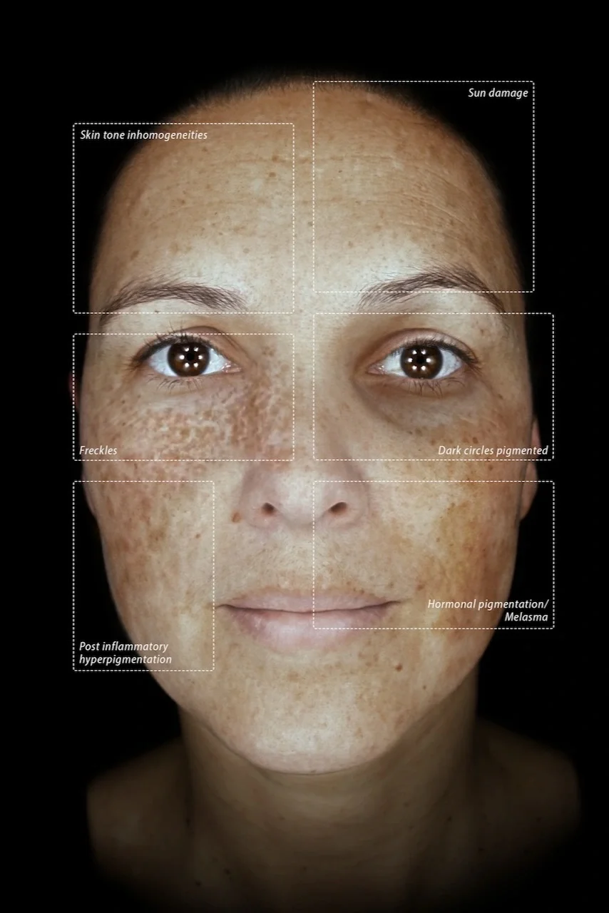 Close-up of a woman's face with labels indicating various skin conditions: sun damage, skin tone inhomogeneities, freckles, dark circled pigmented areas, post-inflammatory hyperpigmentation, and hormonal pigmentation or melasma.