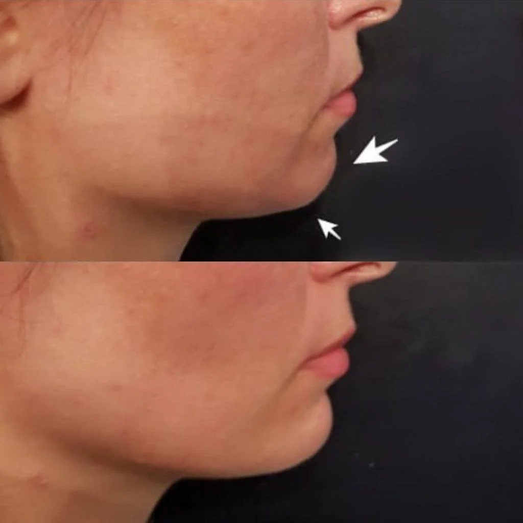 Comparison of a person's chin and jawline before and after a cosmetic procedure, with arrows pointing to the treated area.