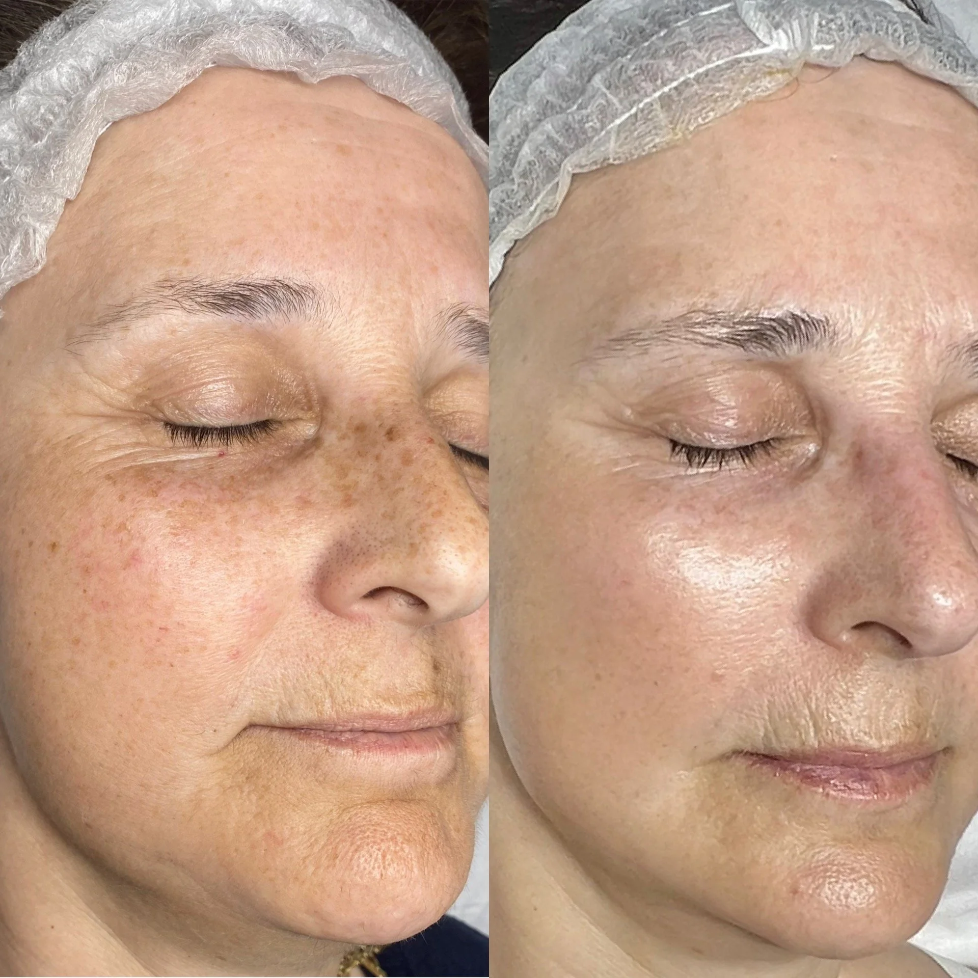 Close-up comparison of a person's forehead and brow area before and after skincare treatment, showing reduction in redness and skin imperfections.