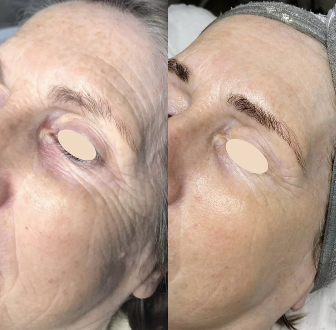 Side-by-side comparison of a woman's face, showing before and after cosmetic facial treatment. The left image depicts a face with visible fine lines, wrinkles, and uneven skin texture, while the right image shows smoother skin, reduced wrinkles, and more defined eyebrows.