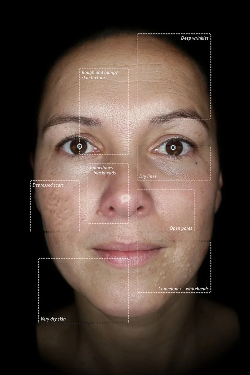 Close-up of a woman's face with labels pointing to different skin issues such as deep wrinkles, rough and bumpy skin texture, comedones or blackheads, depressed scars, dry lines, open pores, whiteheads, and very dry skin.